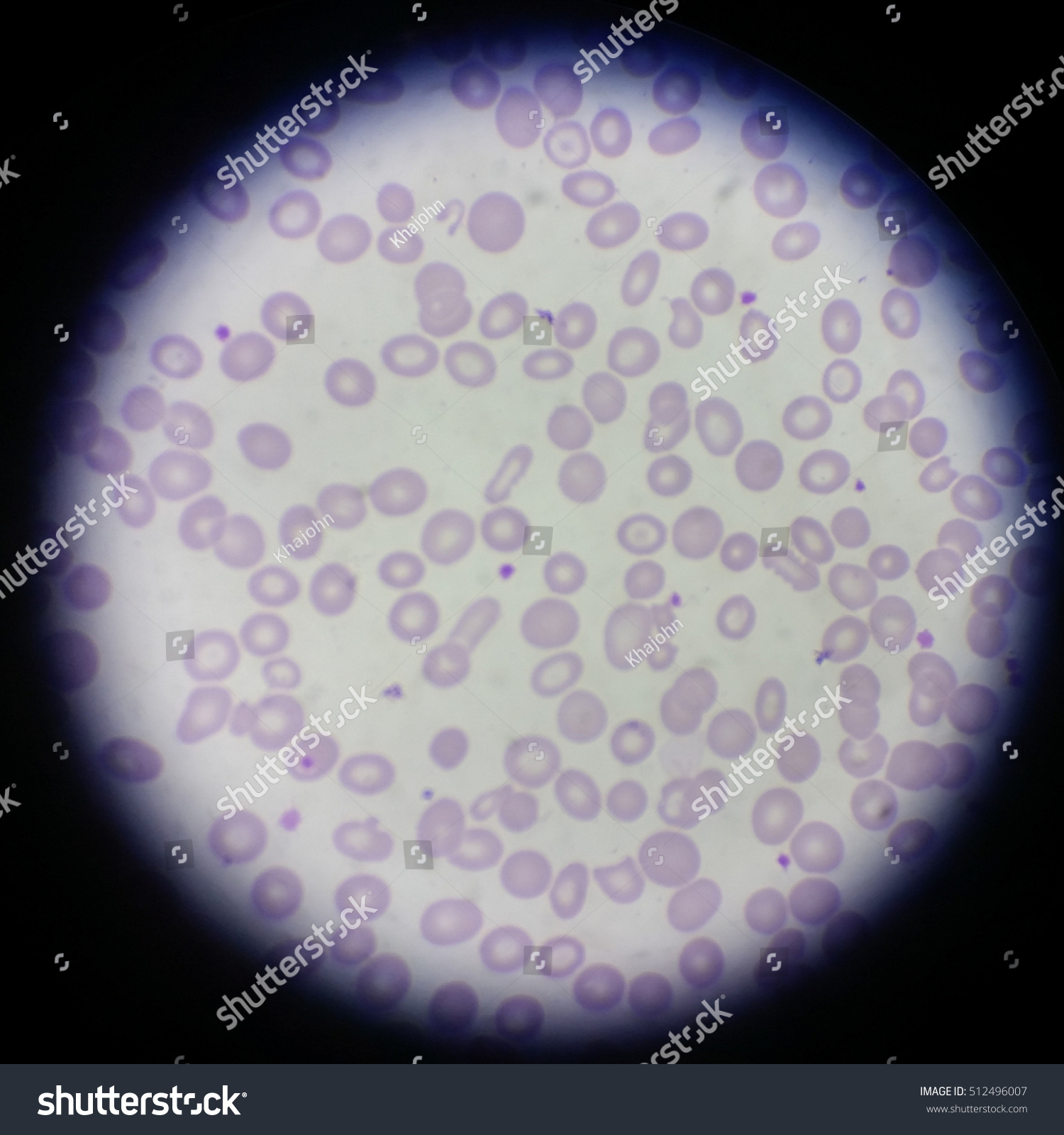 Thalassemia Blood Smear