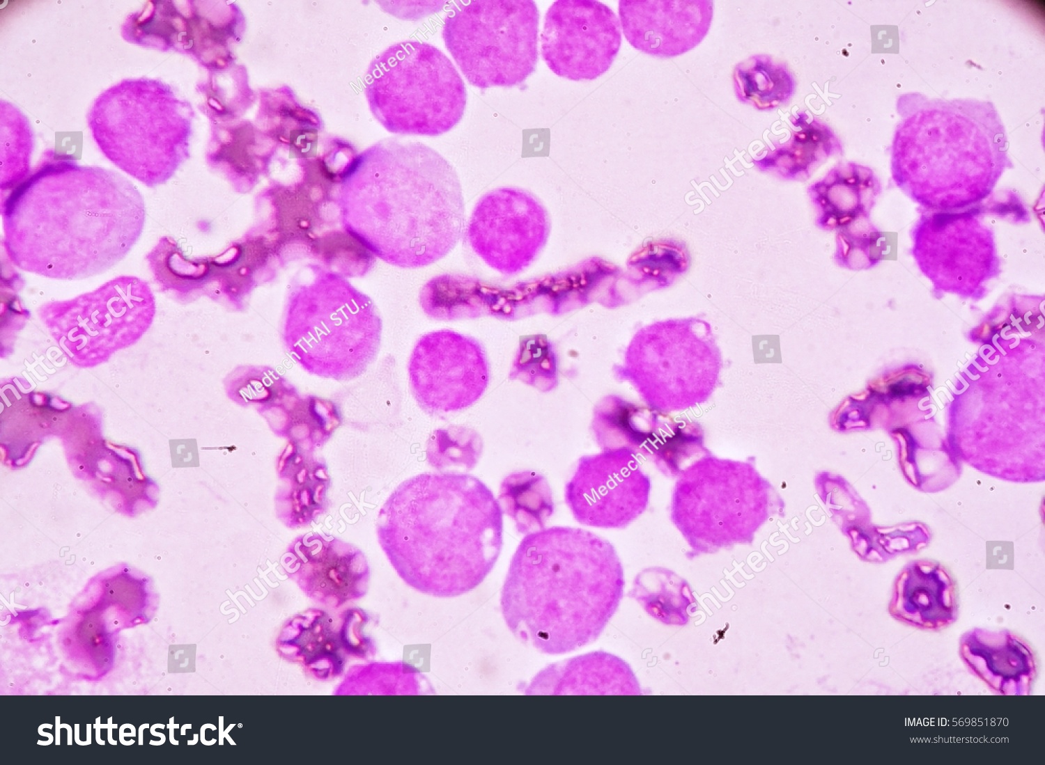 Blood Smear Under Microscopy Showing On Stock Photo 569851870 ...