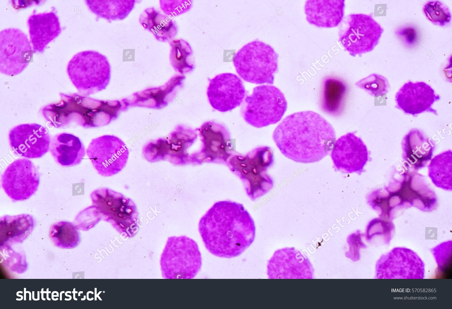 Blood Smear Under Microscopy Showing On Stock Photo 570582865 ...