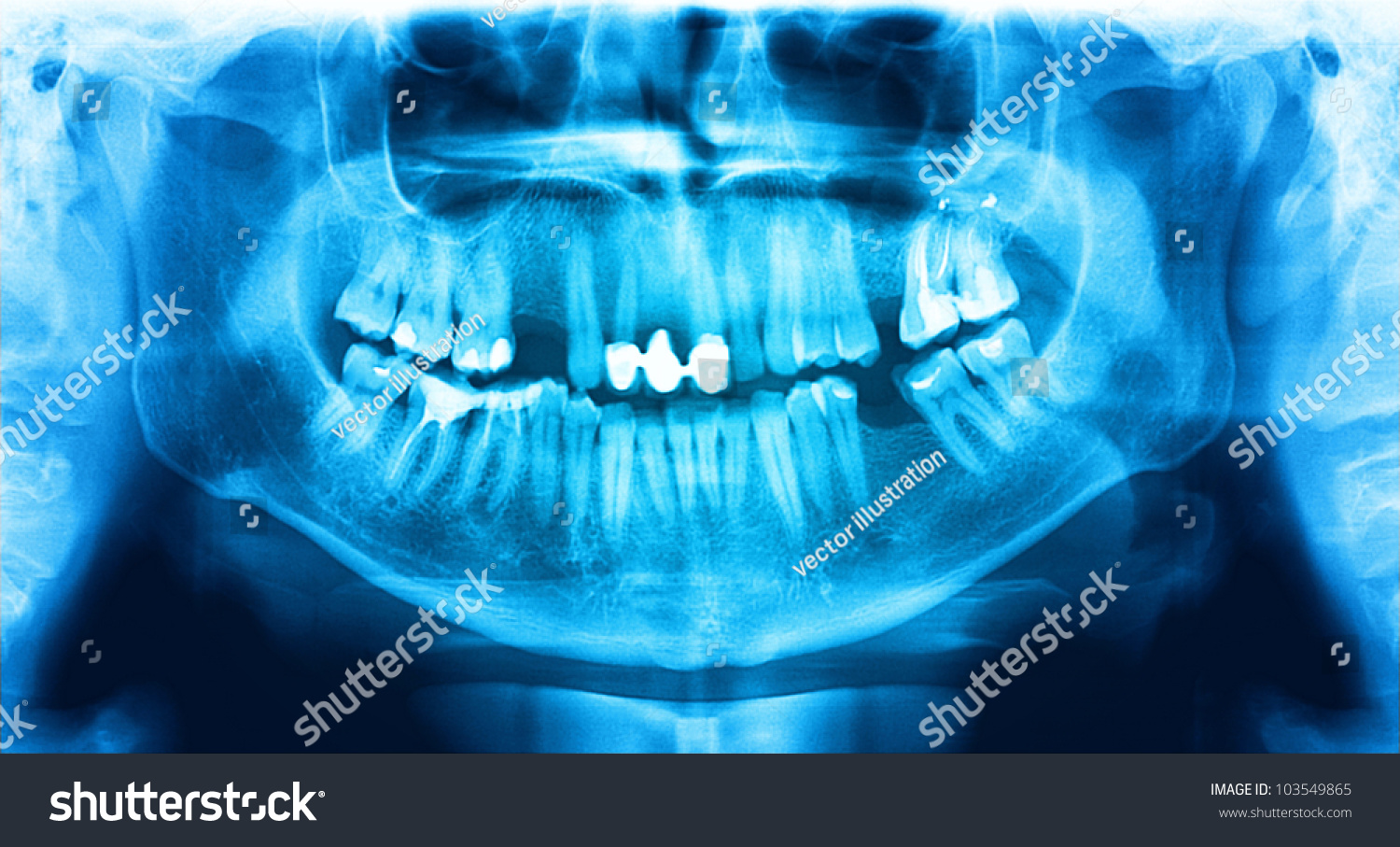 Blue Xray Teeth Scan Mandible Panoramic Stock Photo 103549865 ...