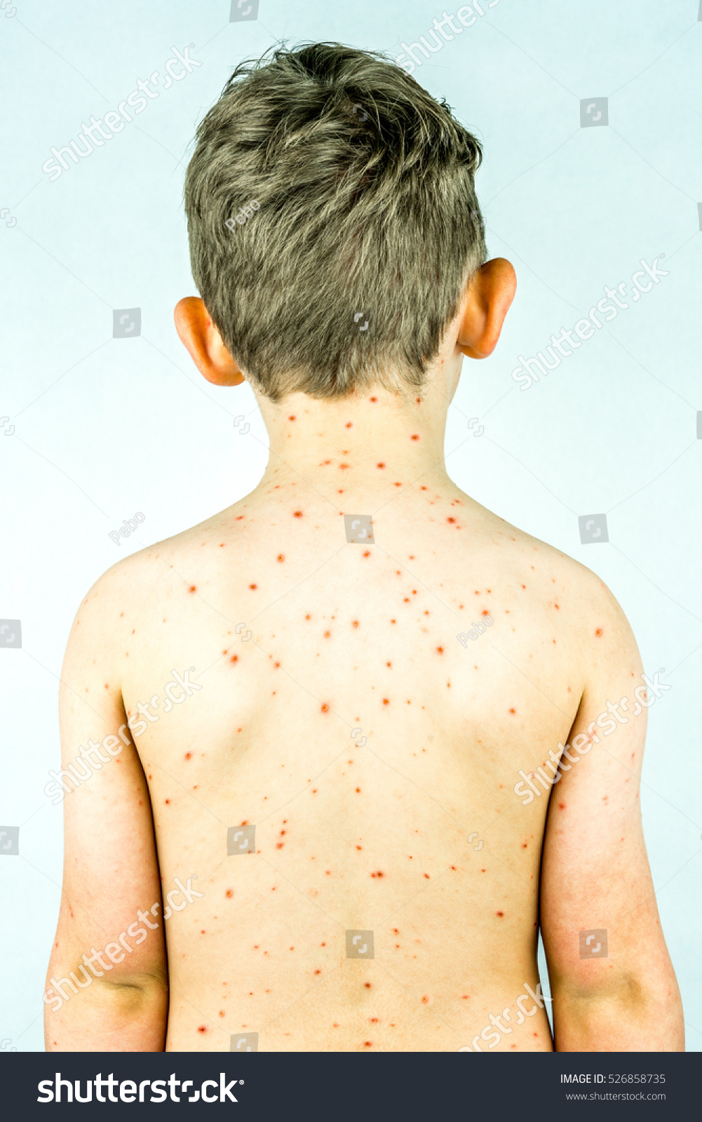 Boy Chickenpox Back Rash Blisters Studio Stock Photo 526858735 ...