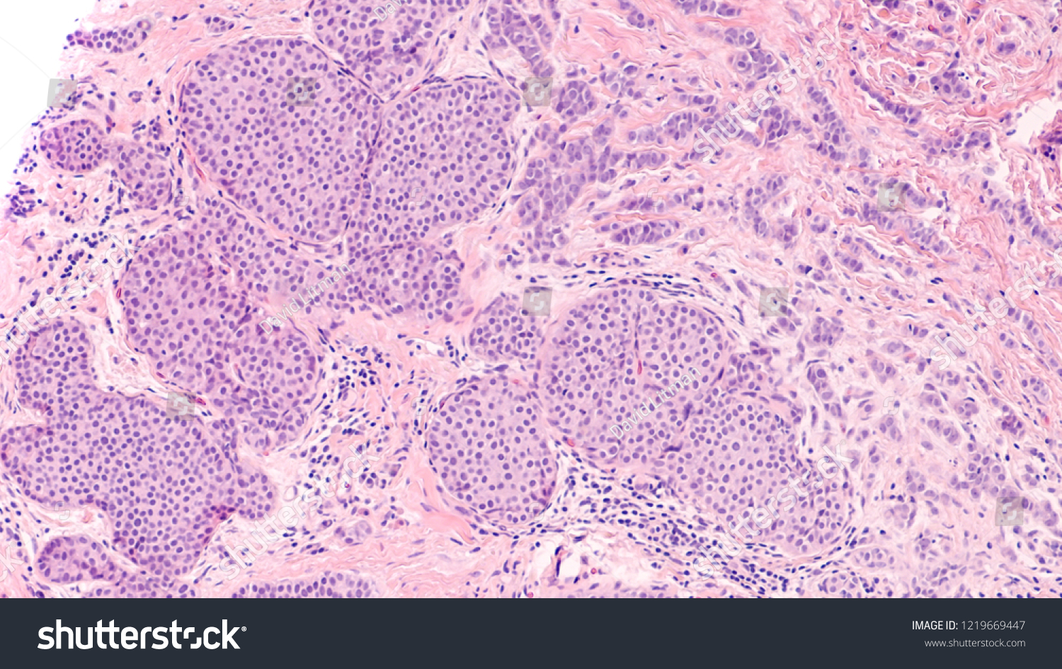 breast-cancer-histology-lobular-carcinoma-situ-foto-de-stock-editar