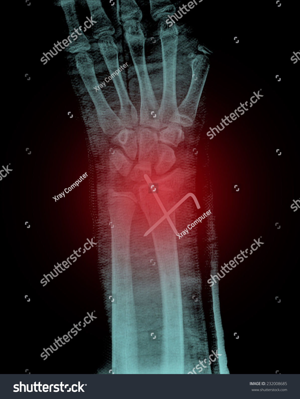 Broken Xray Human Hand Wrist Stock Photo 232008685 | Shutterstock