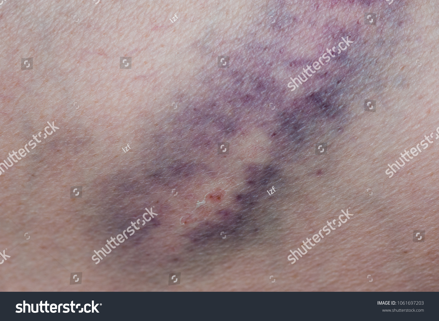 Bruise Injury On Young Woman Knee Stock Photo 1061697203 | Shutterstock