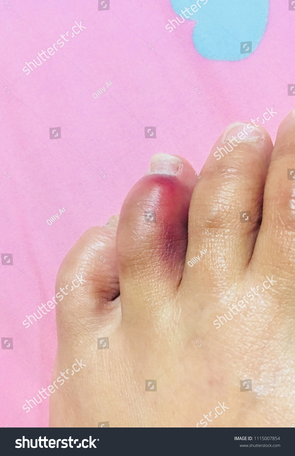 Bruises Bunions Broken Toes On Pink Stock Photo Edit Now 1115007854