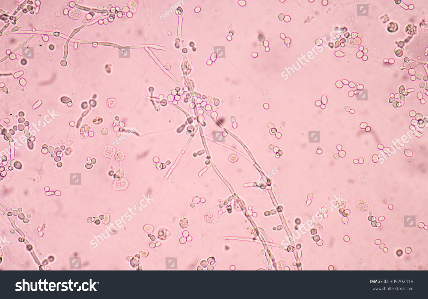 Budding Yeast Cells With Pseudohyphae In Urine Sample Fine With ...