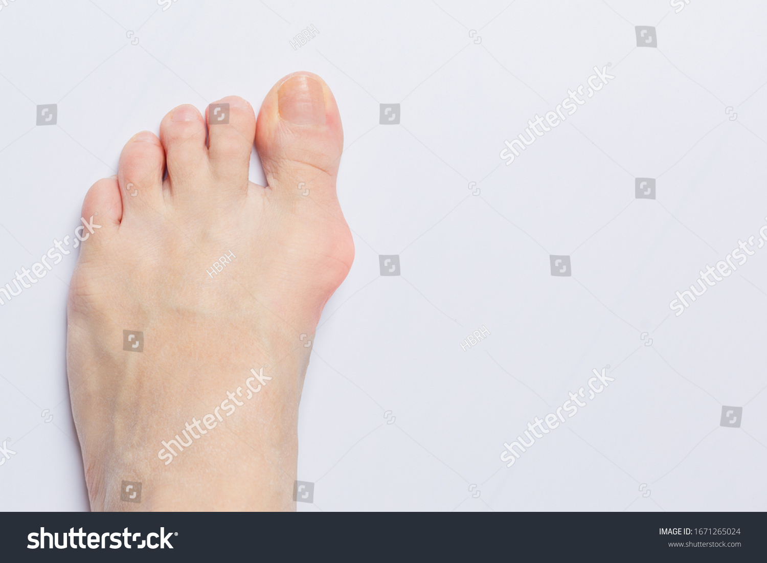 Feet Bunion Images Stock Photos Vectors Shutterstock