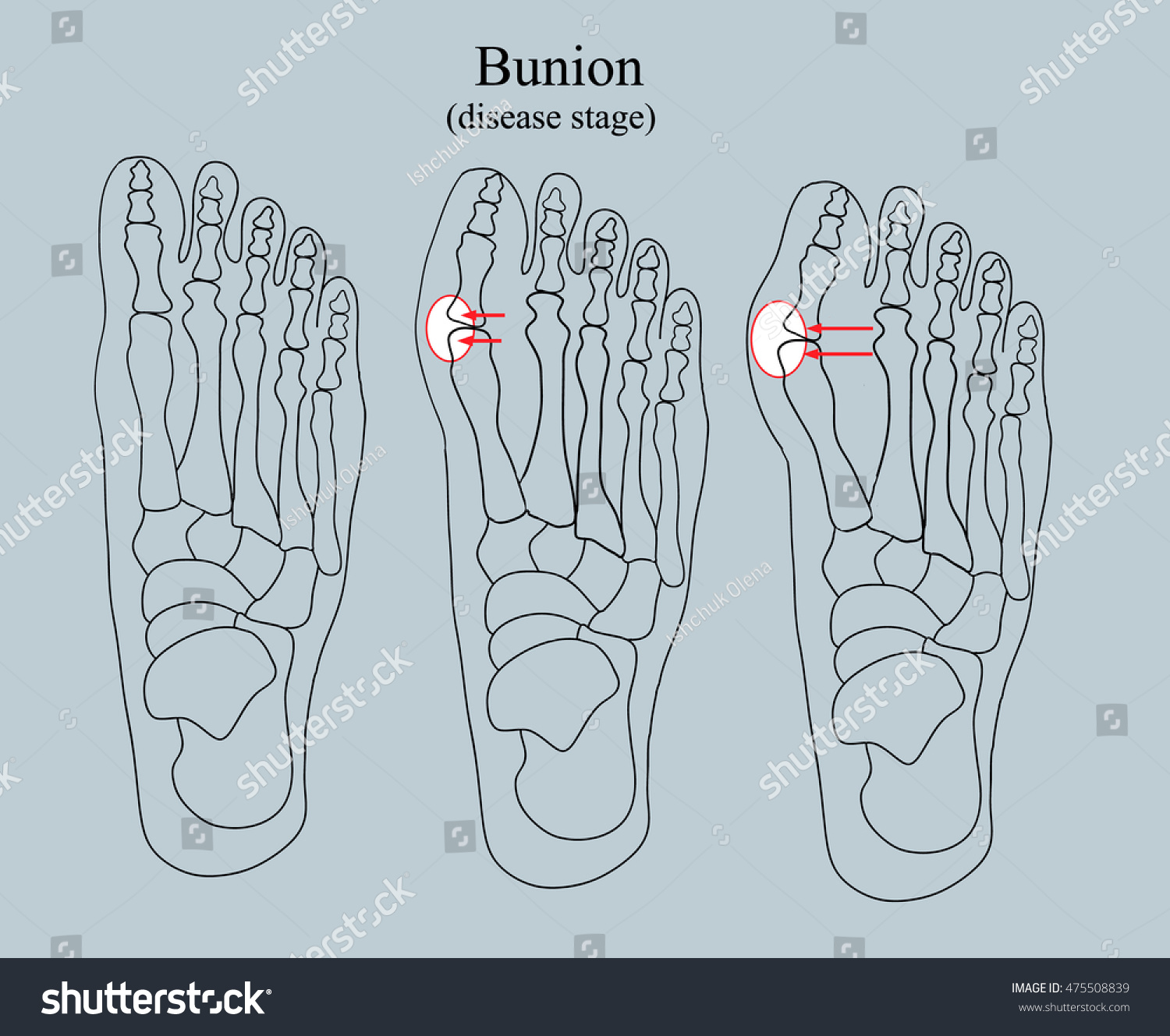 Bunion Disease Stage Black White Illustration Stock Illustration ...