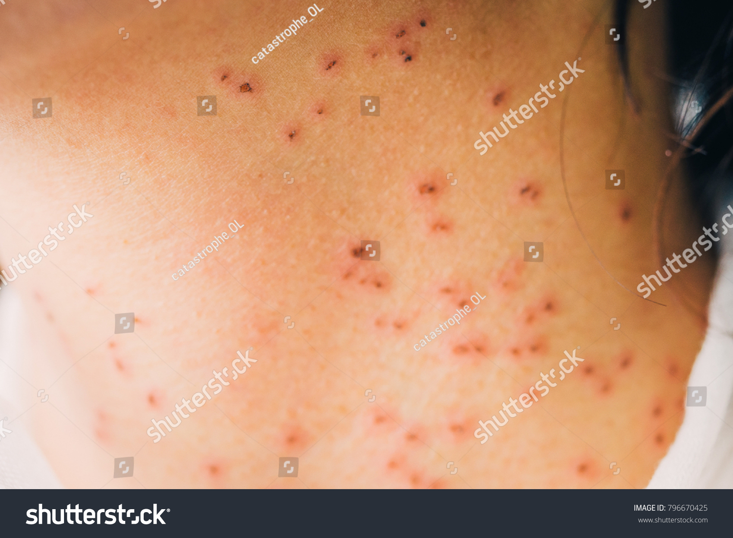 Burns Spots Laser Treatment Freckles Age Stock Photo Edit Now