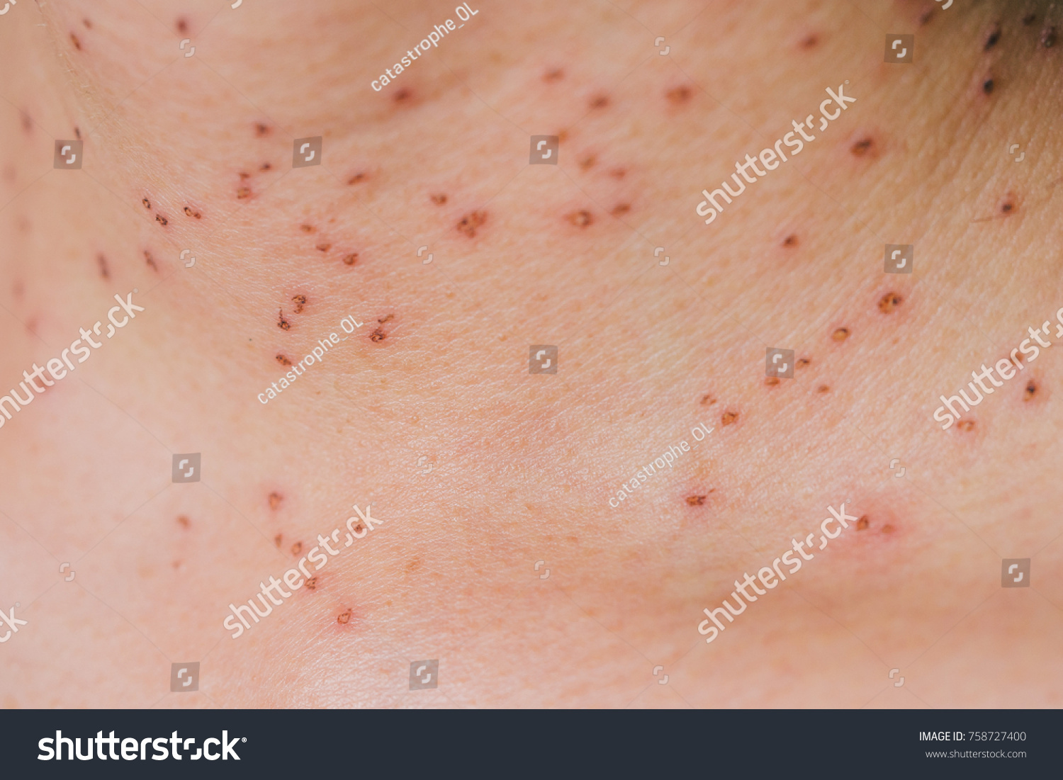 Burns Spots Scabs Laser Treatment Freckles Stock Photo Edit Now