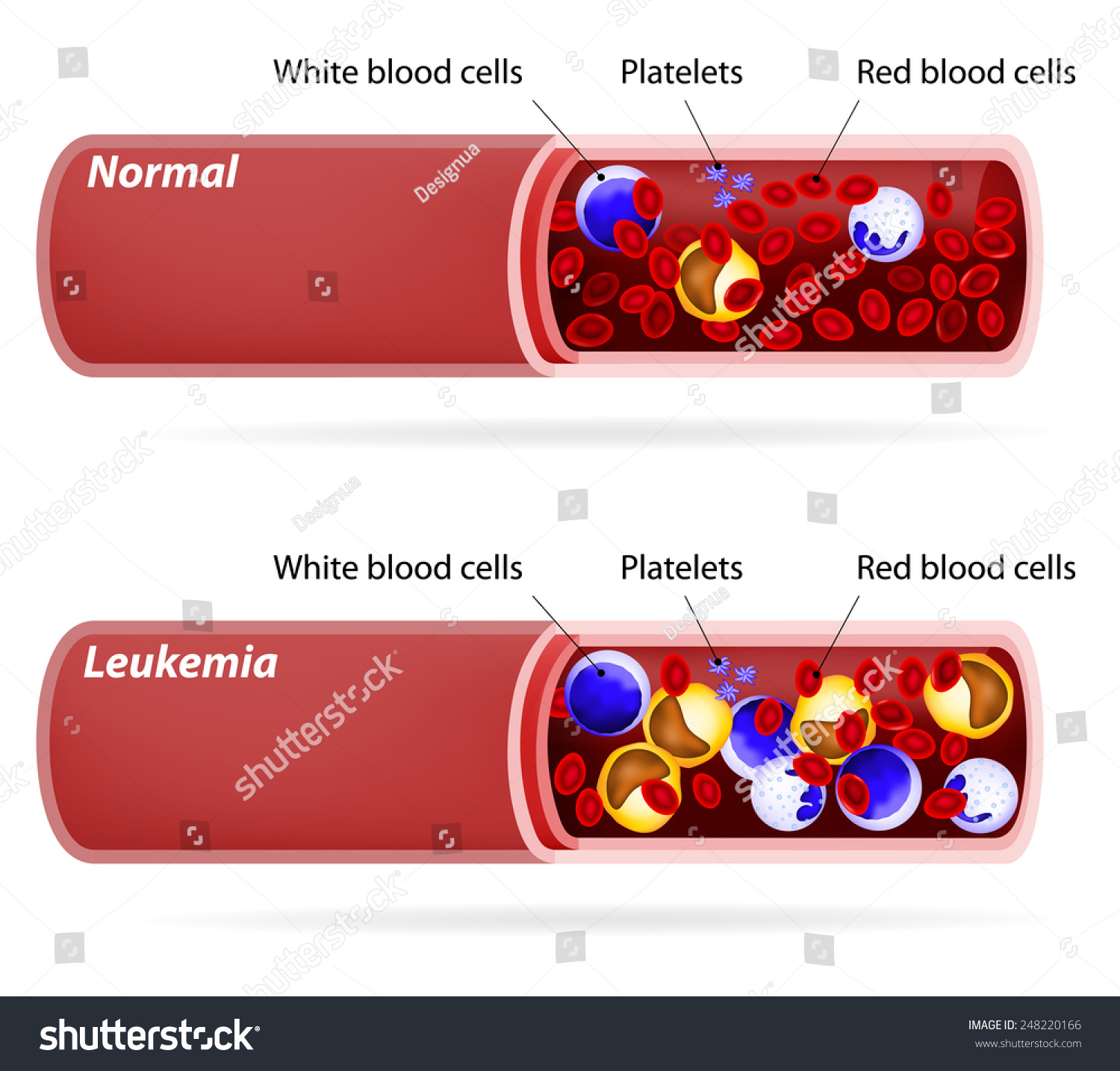 Cancer. Blood Vessels With Red Blood Cells And White Blood Cells ...