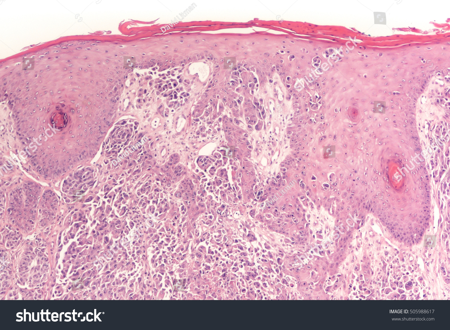 melanoma histology