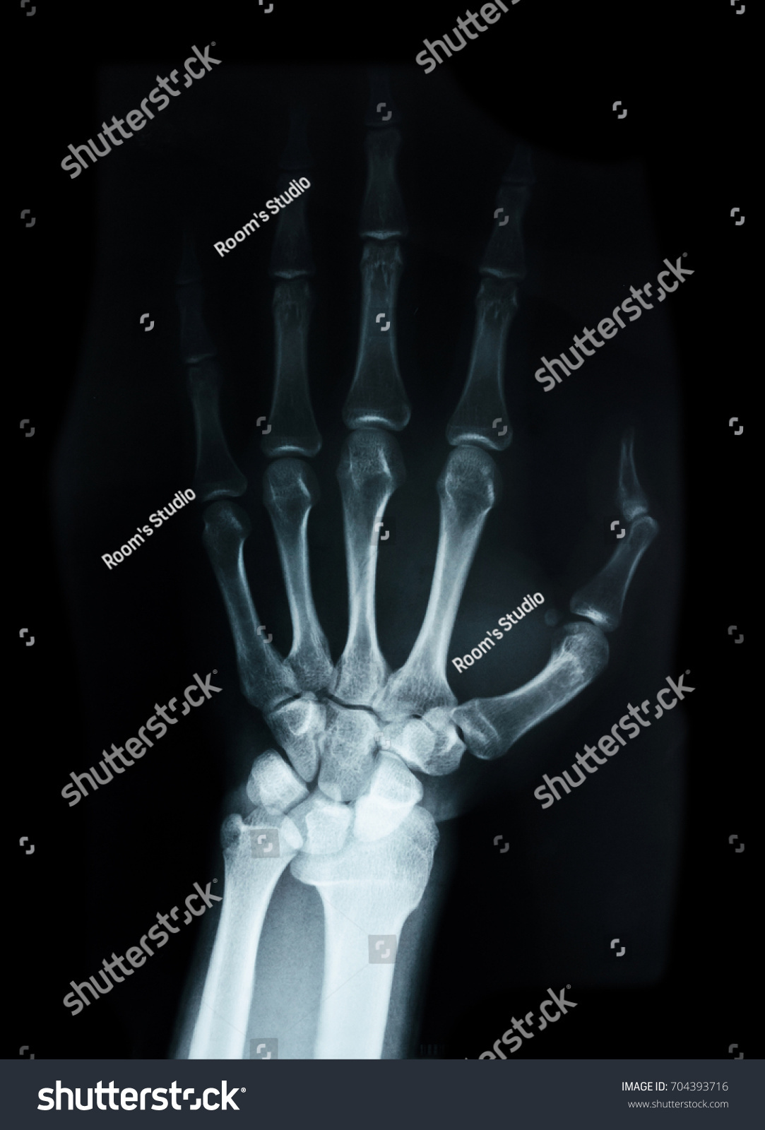 Carpal Bones Human X Ray On Stock Photo 704393716 | Shutterstock