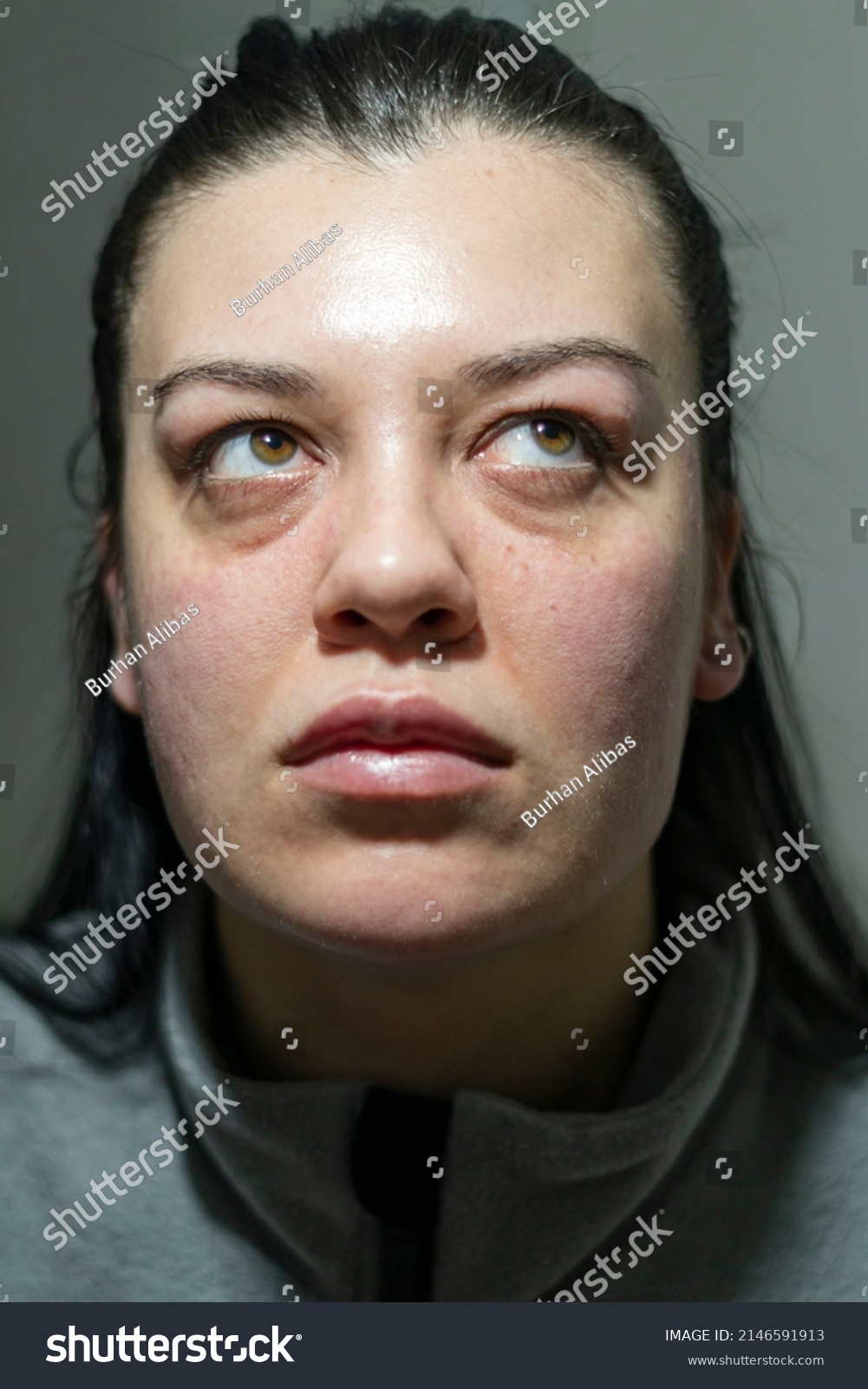 Caucasian Woman Allergic Reaction Problematic Face Stock Photo ...