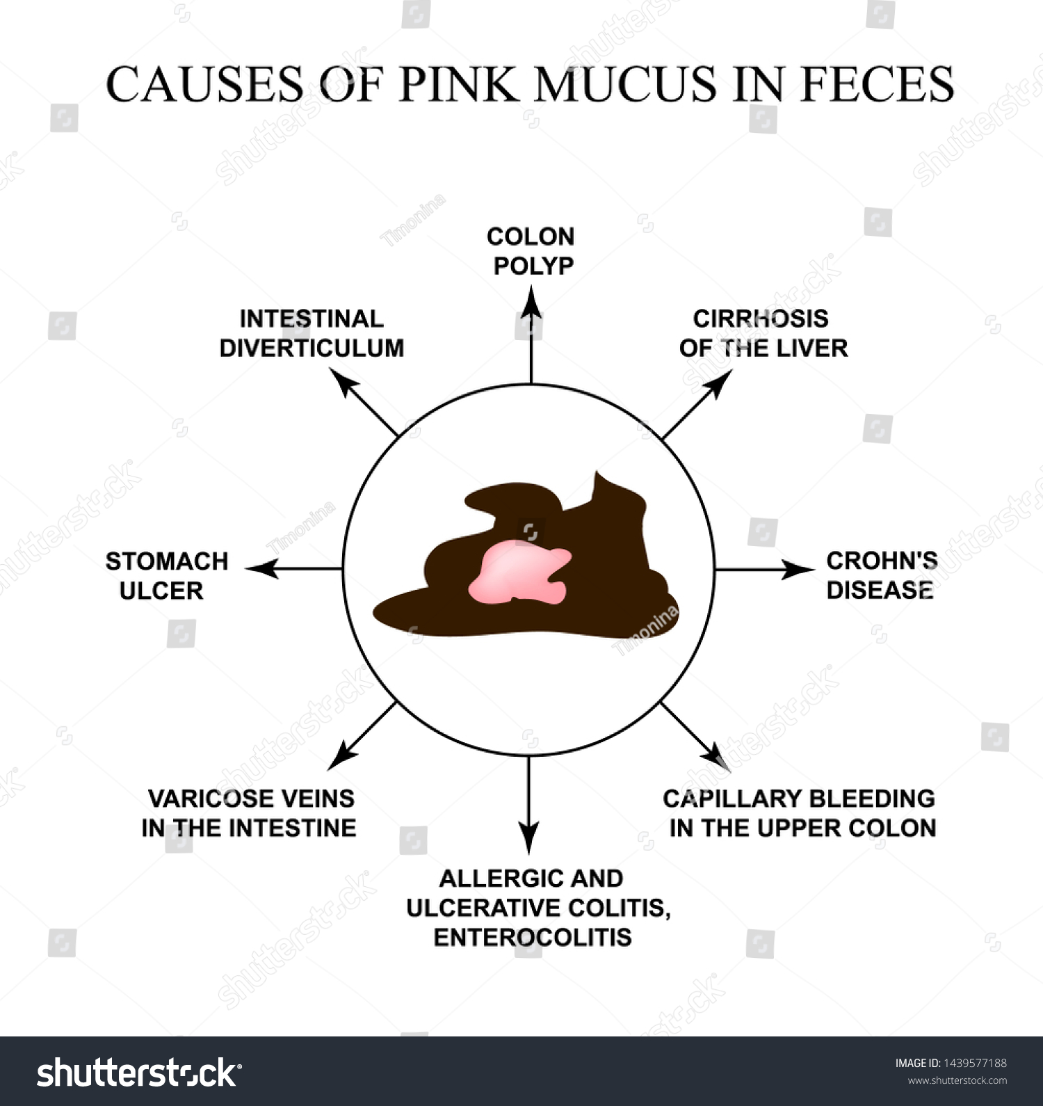 Causes Pink Mucus Feces Diseases Gastrointestinal Stock Illustration ...