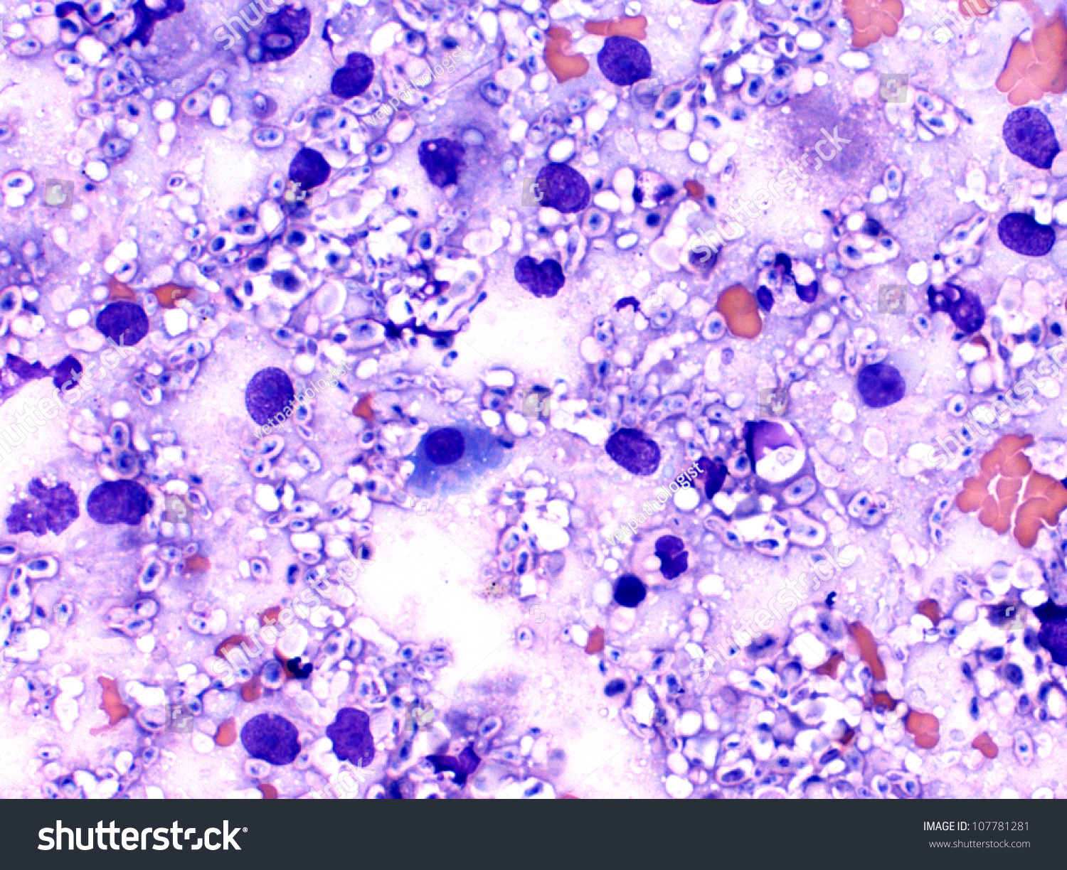 Cellular Smear Of Cryptococcus Fungi - Lung And Nasal Cavity Cytology ...