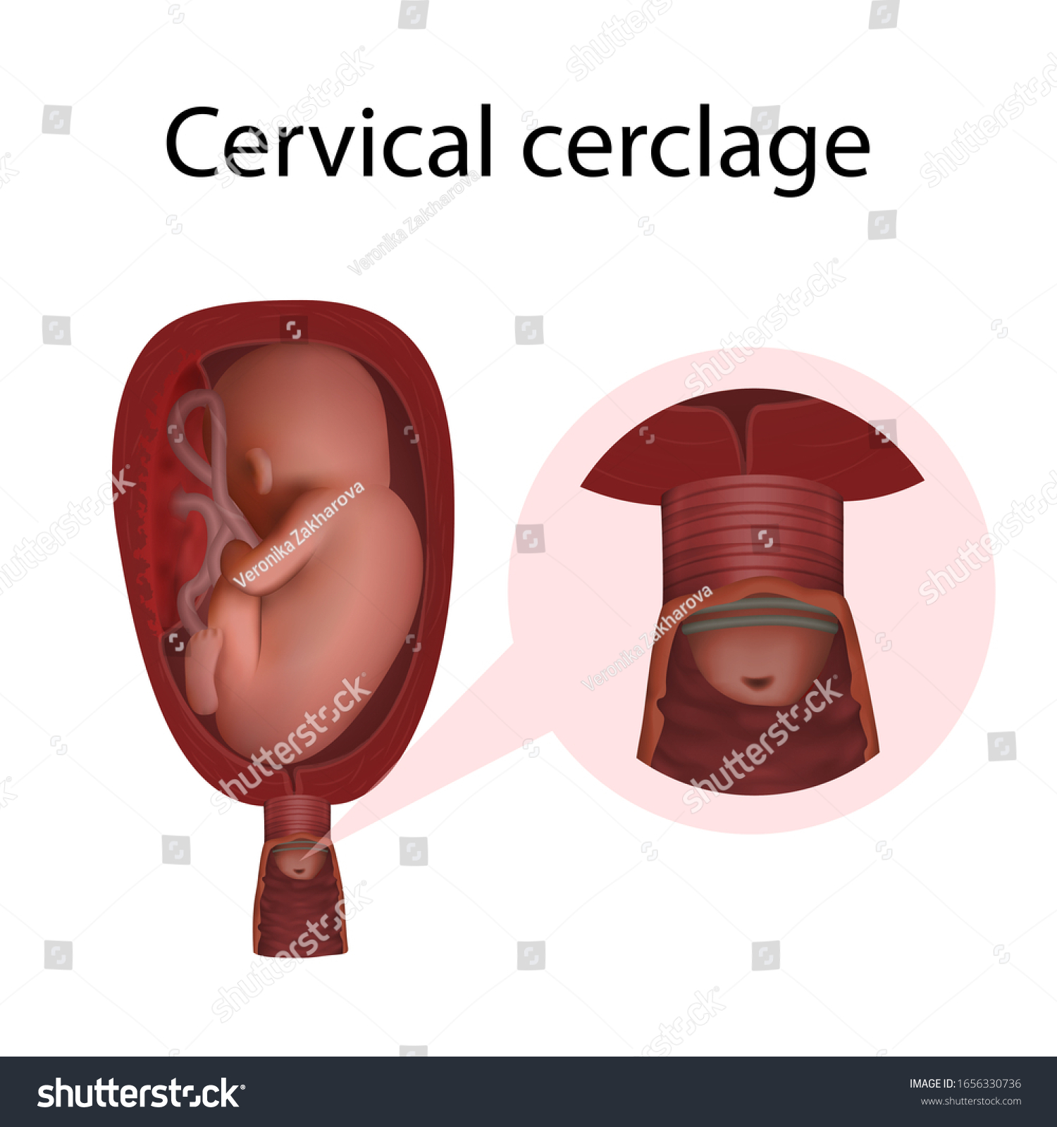 Cervical Cerclage Cervical Weakness Fetus Uterus Stock Illustration ...