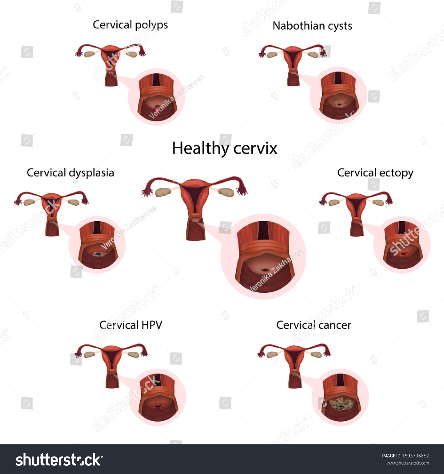 Cervical Diseases Cervix Polyps Ectopy Dysplasia Ilustrações Stock 1593796852 