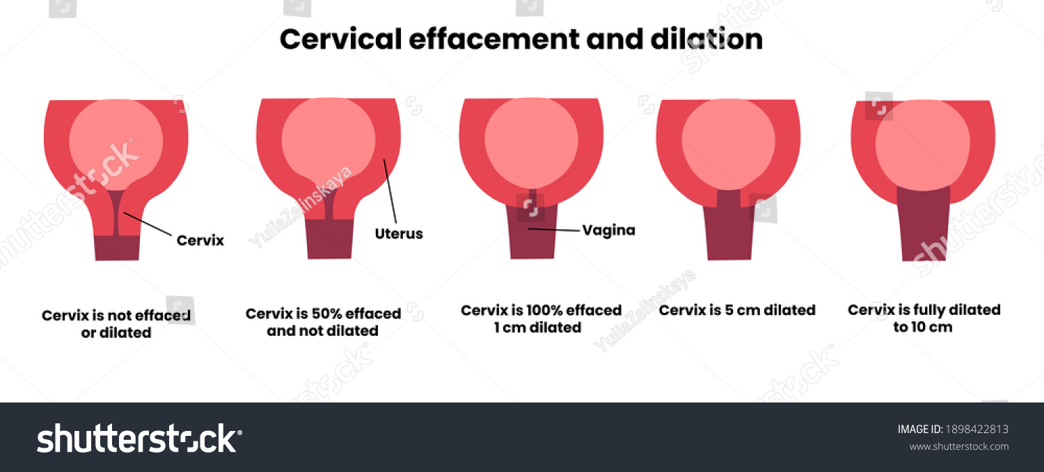 Cervical Effacement Dilation During Childbirth 1 Stock Illustration ...