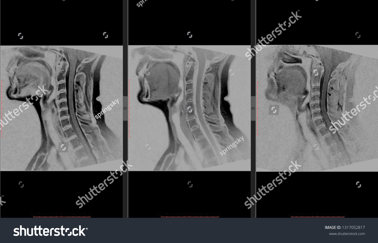 Cervical Mri Scan Magnetic Resonance Imaging Stock Photo Edit Now Cervical Mri Scan Magnetic Resonance Imaging Stock Photo Edit Now