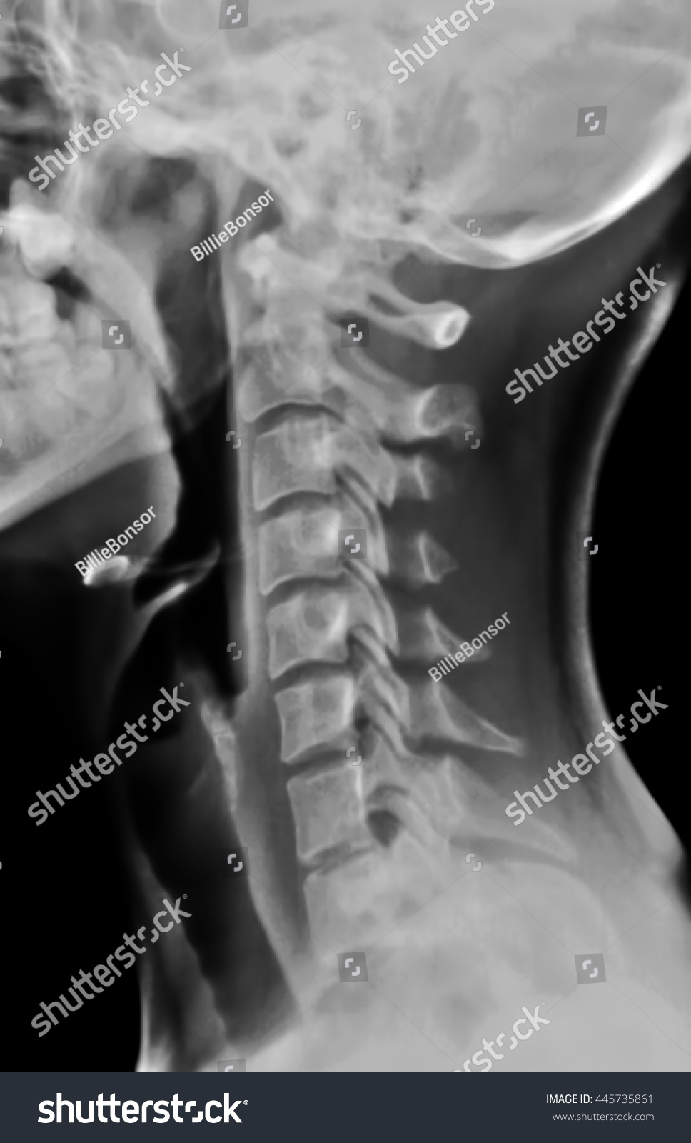 Cervical Spine - Lateral Stock Photo 445735861 : Shutterstock