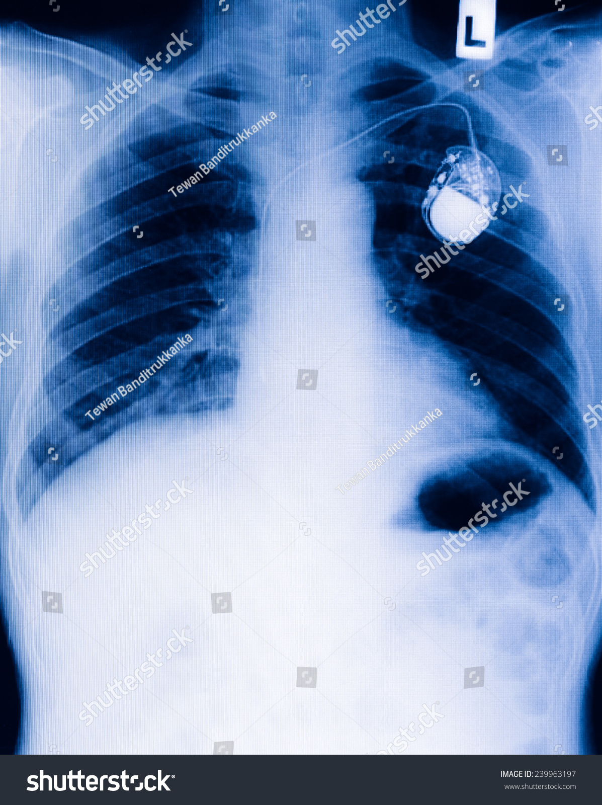 Chest Pacemaker On Xray Film Stock Photo 239963197 - Shutterstock