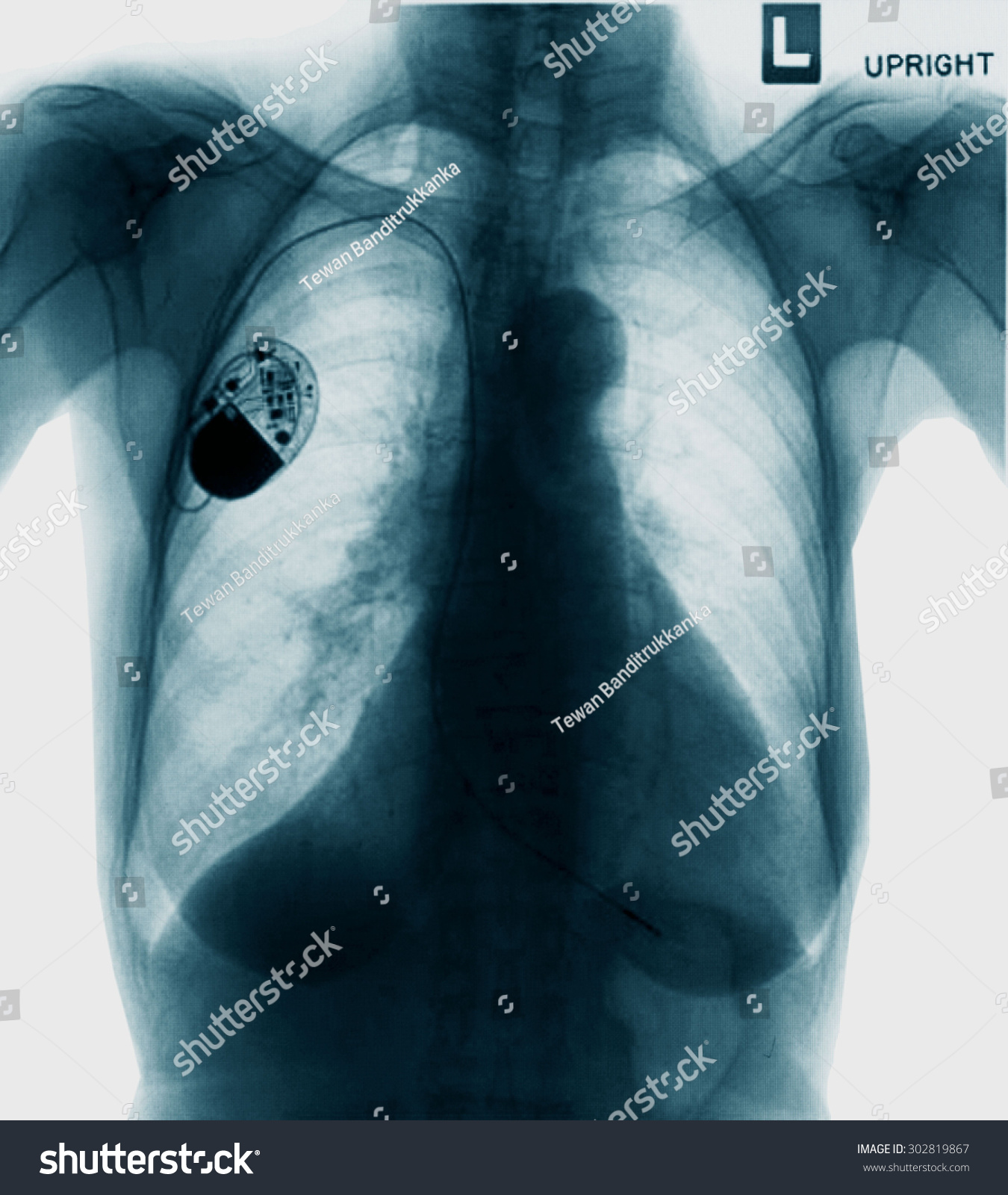 Chest With The Pacemaker On X-Ray Film Stock Photo 302819867 : Shutterstock