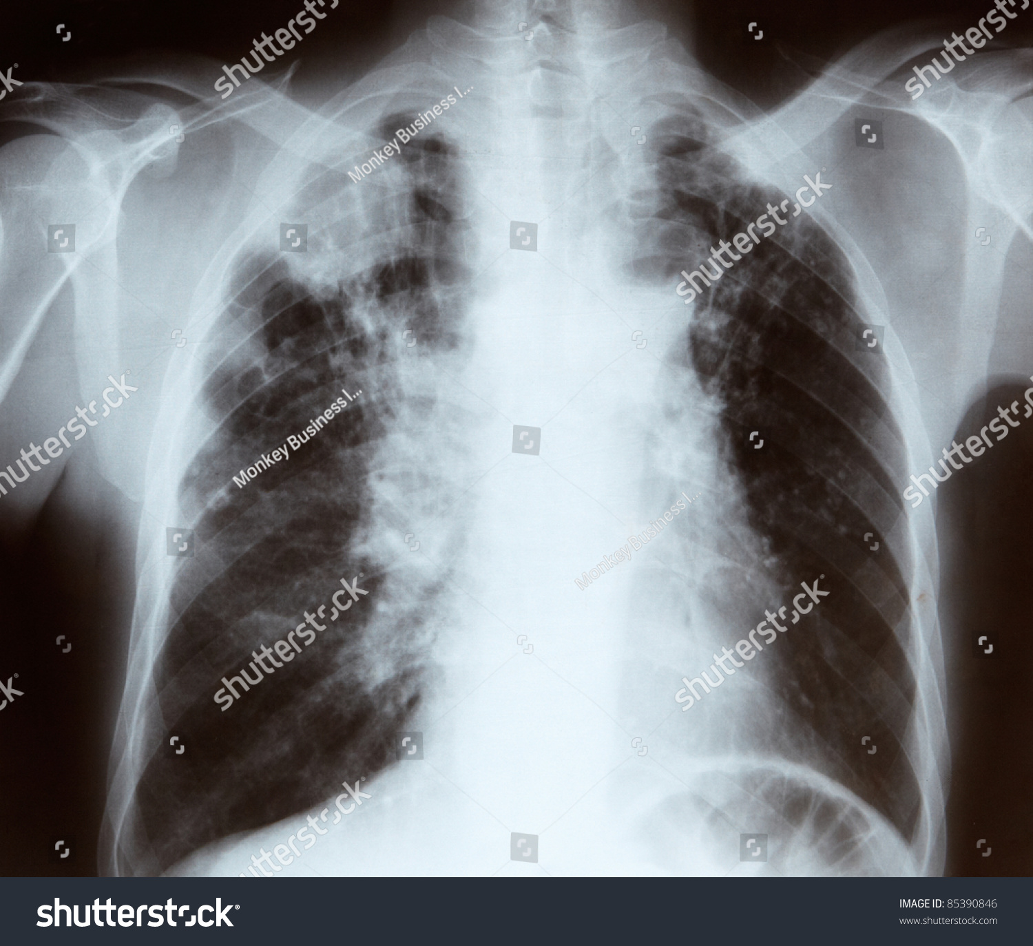 Chest X-Ray Stock Photo 85390846 : Shutterstock