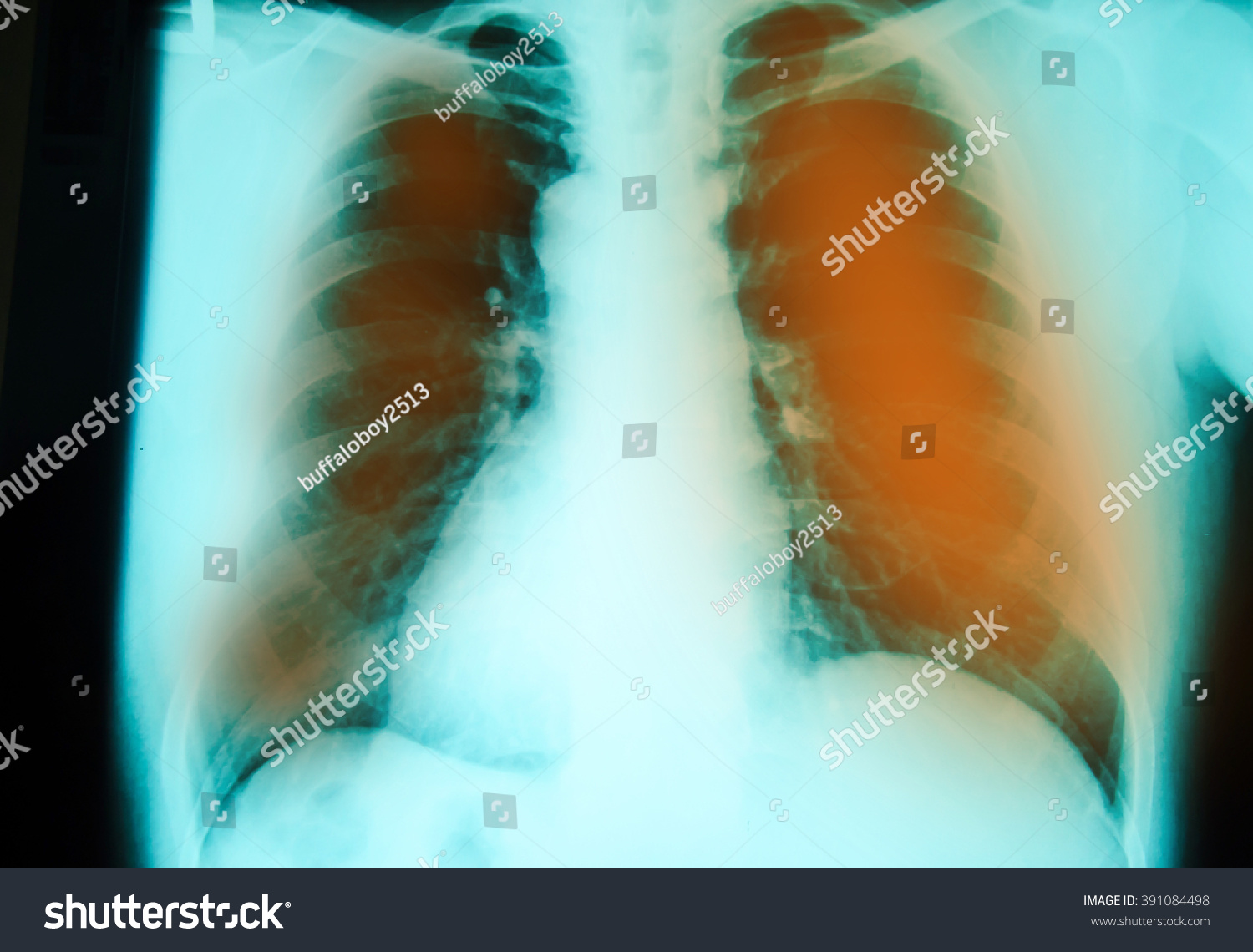 Chest Xray Examination Diagnosis Pulmonary Tuberculosis Stock Photo ...