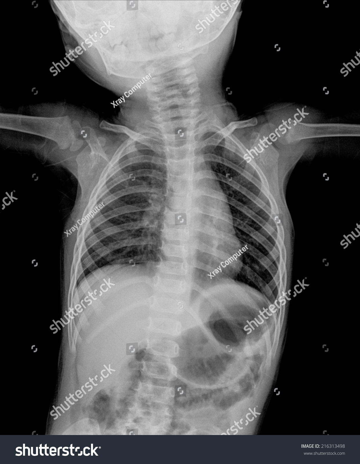 Chest Xray Film Children Chest Posteroanterior Stock Photo 216313498 ...