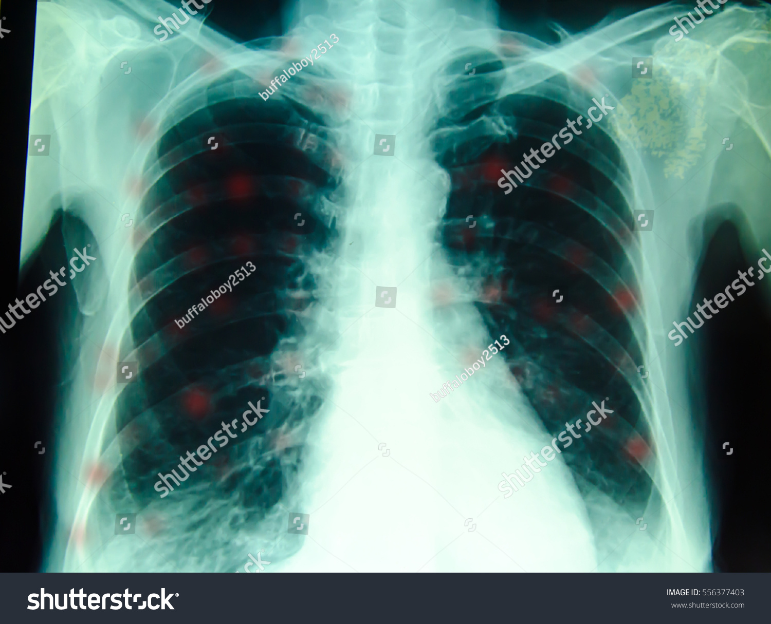 Chest Xray Diagnosis Hospital Stock Photo (Edit Now) 556377403