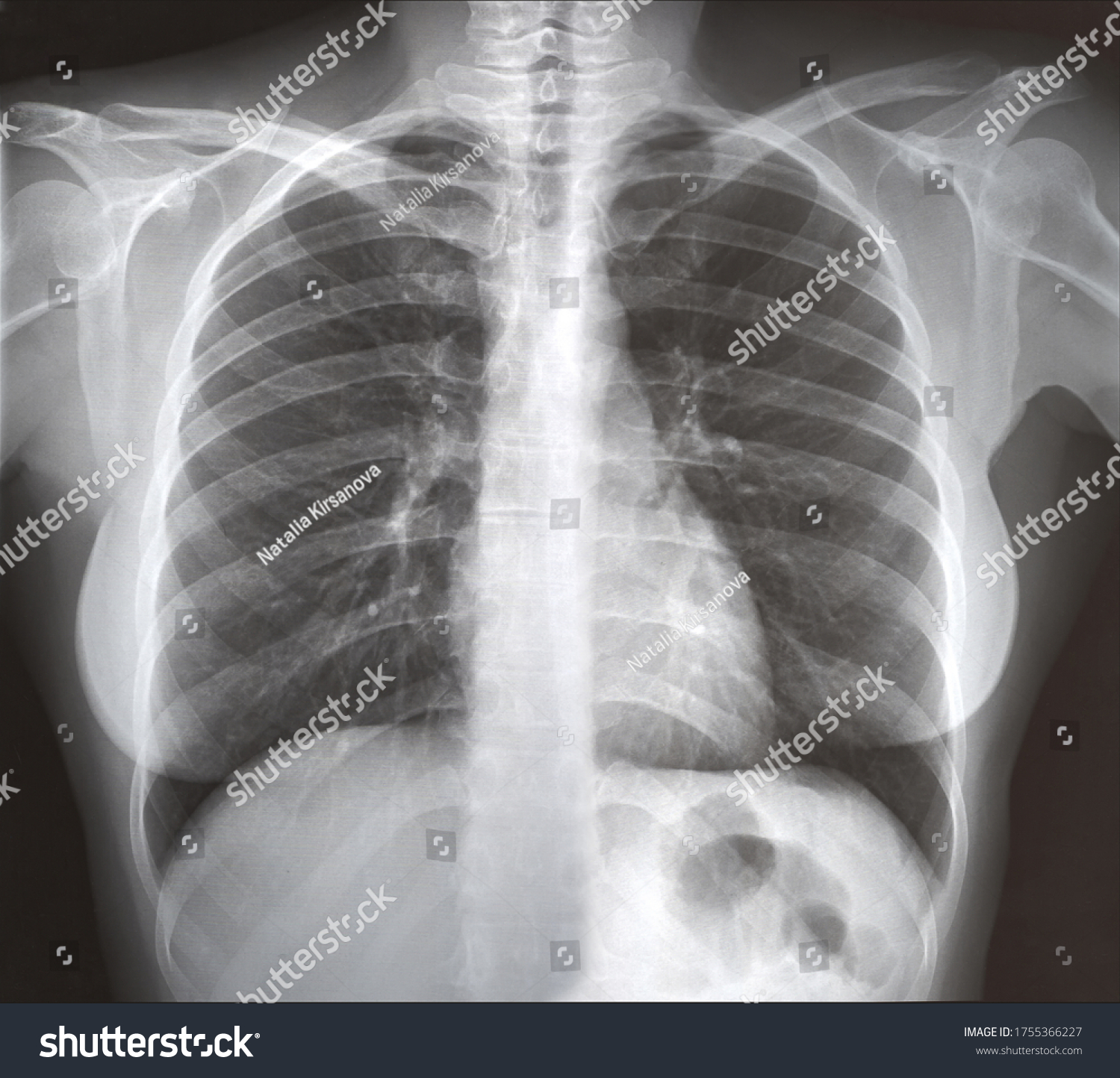 Chest Xray Examination By Doctor Infections Stock Photo (Edit Now ...