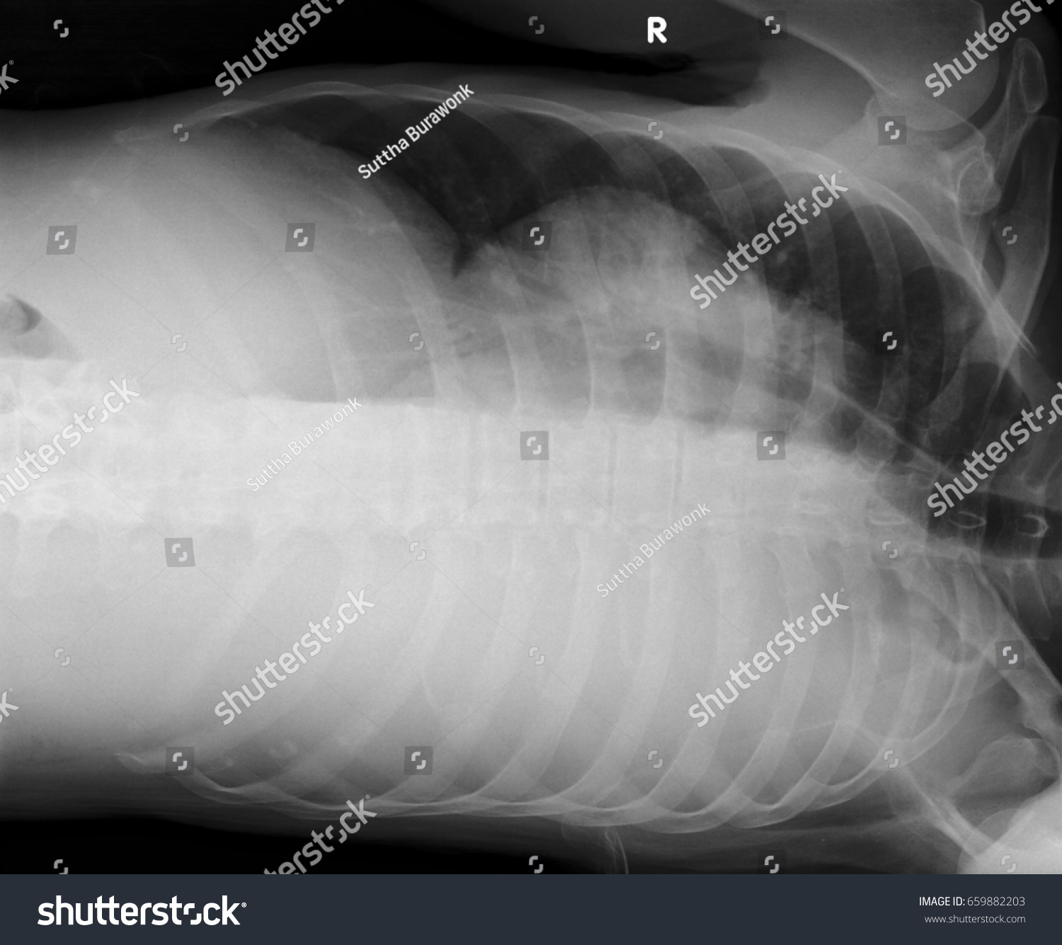 right-lateral-decubitus-position-image-right-to-left-shunting-in-the