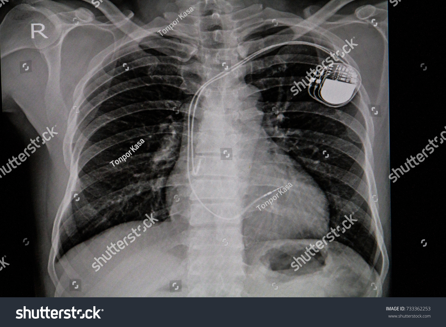 Chest Xray Image Permanent Pacemaker Implant Stock Photo (Edit Now ...