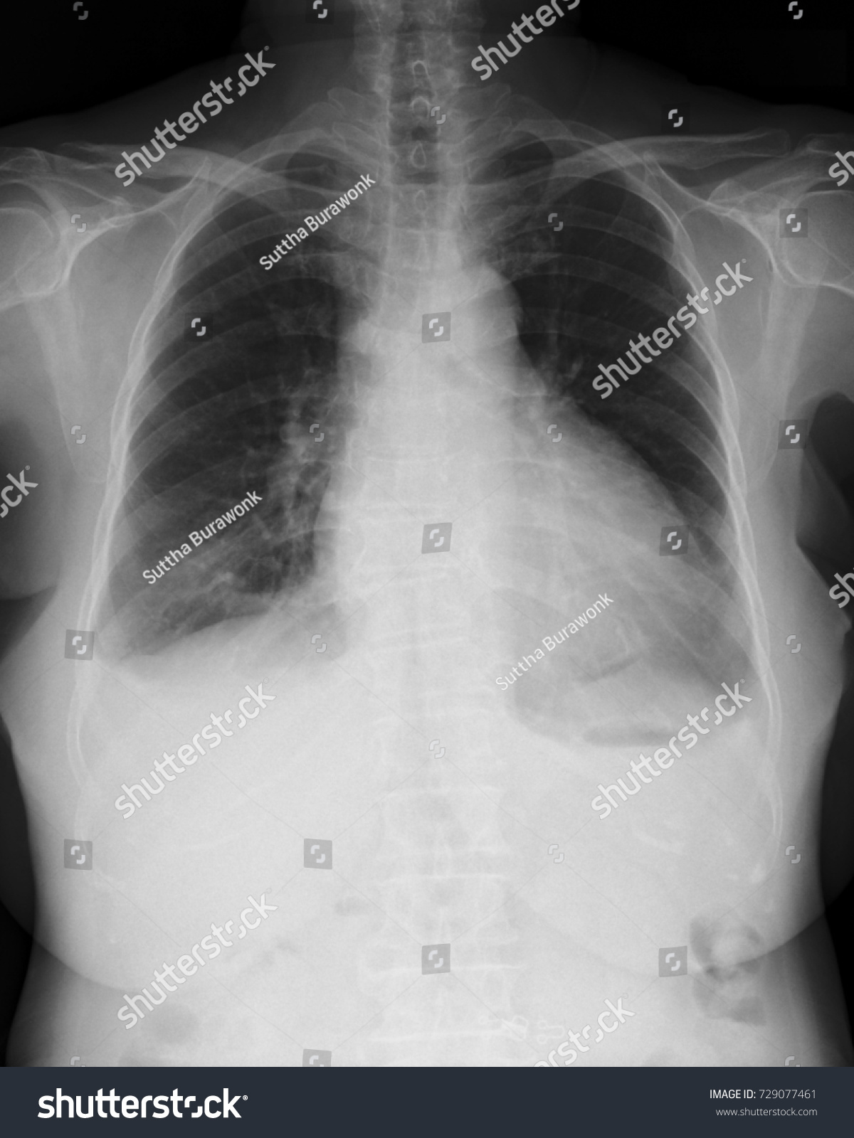 Chest Xray Image Pa Upright Position Stock Photo (Edit Now) 729077461