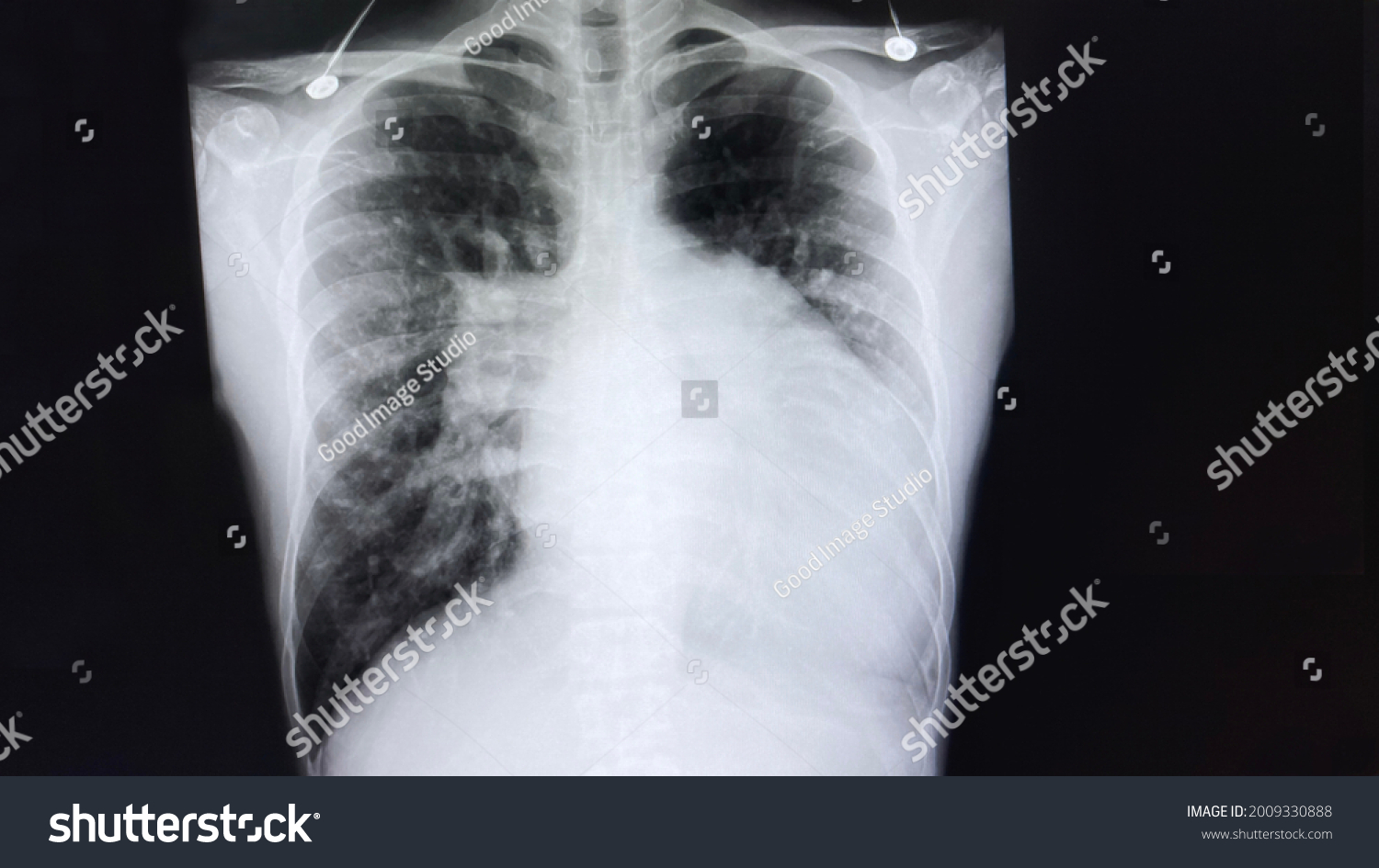 Chest Xray Known Case Covid19 Positive Stock Photo 2009330888 ...