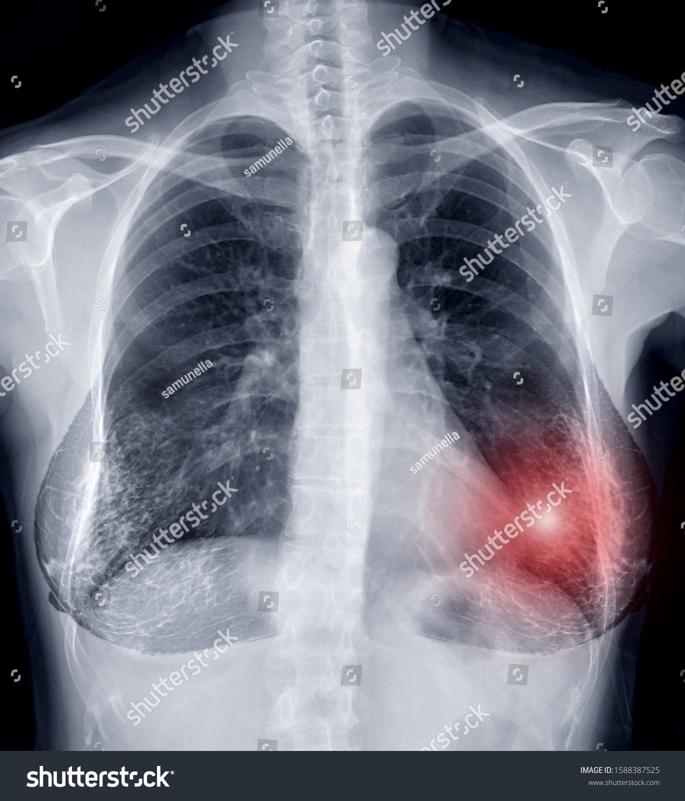 Chest Xray Xray Image Woman Chest Stock Photo Edit Now 1588387525