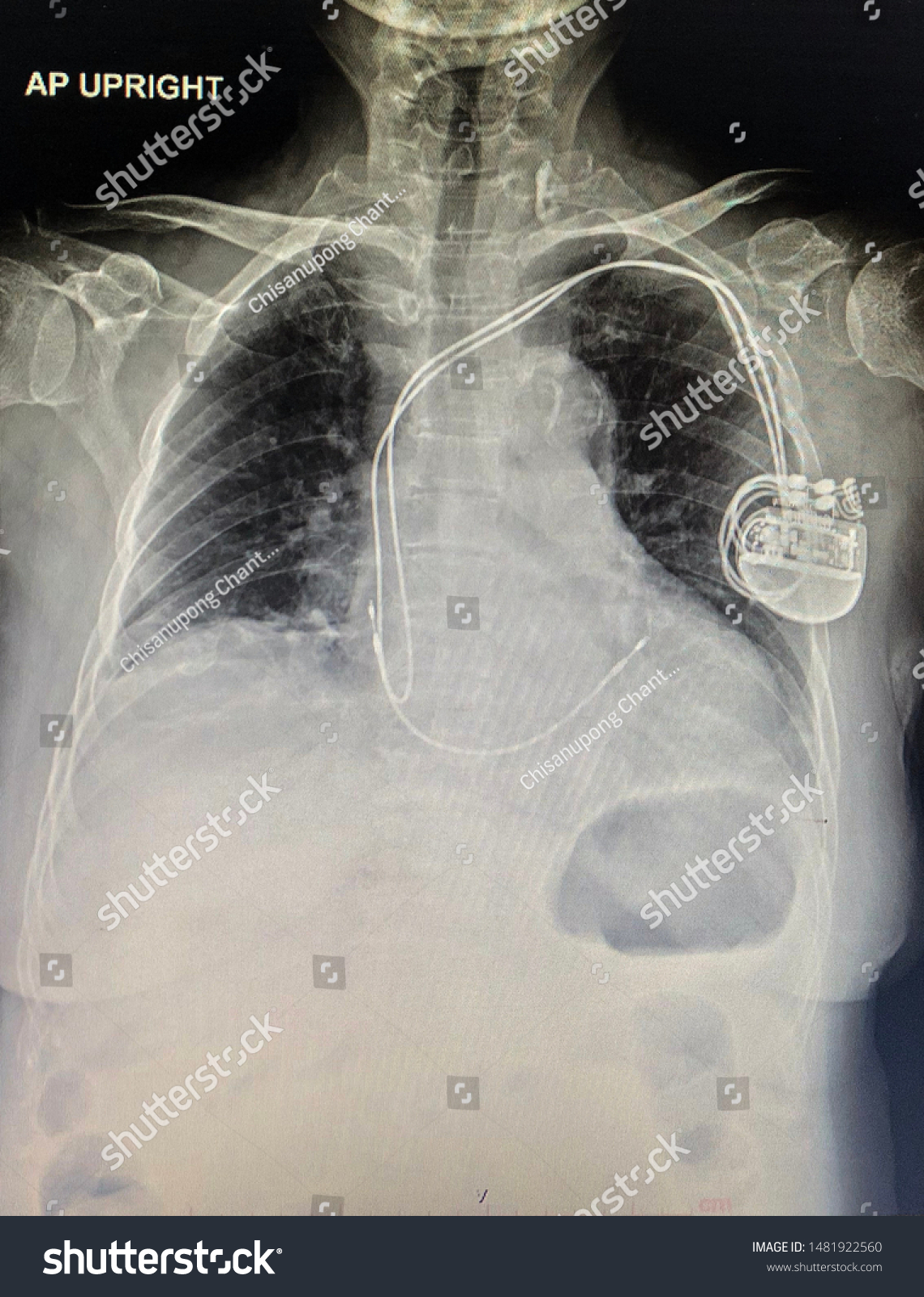 Chest Xray Showed Pacemaker Recurrent Premature Stock Photo (Edit Now ...