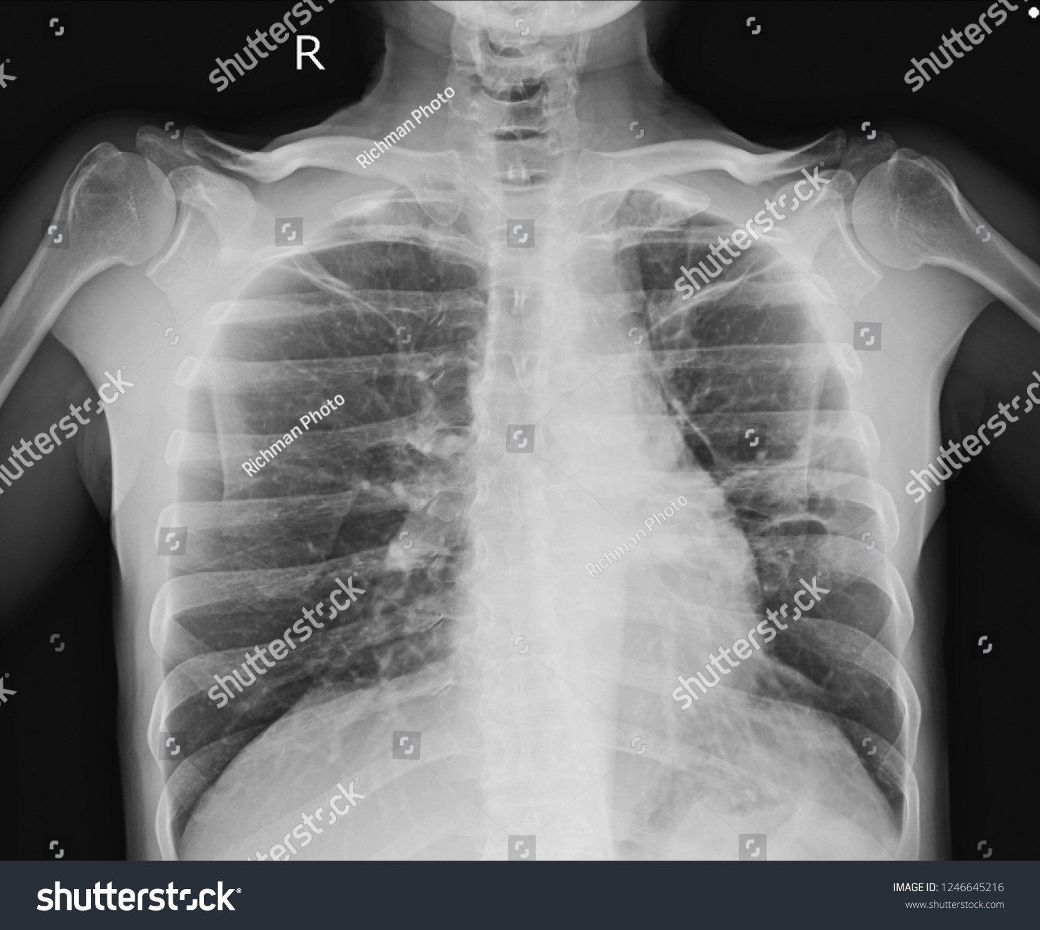 Chest Xray Showing 3 Cm Pleural Stock Photo 1246645216 