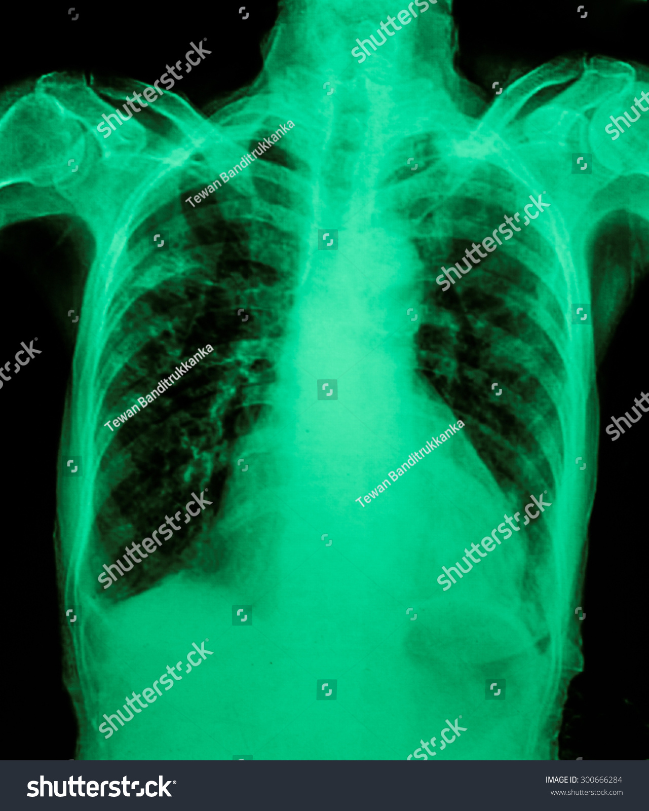 Chest Xray Showing Infiltrate Lung Pneumonia库存照片300666284 Shutterstock