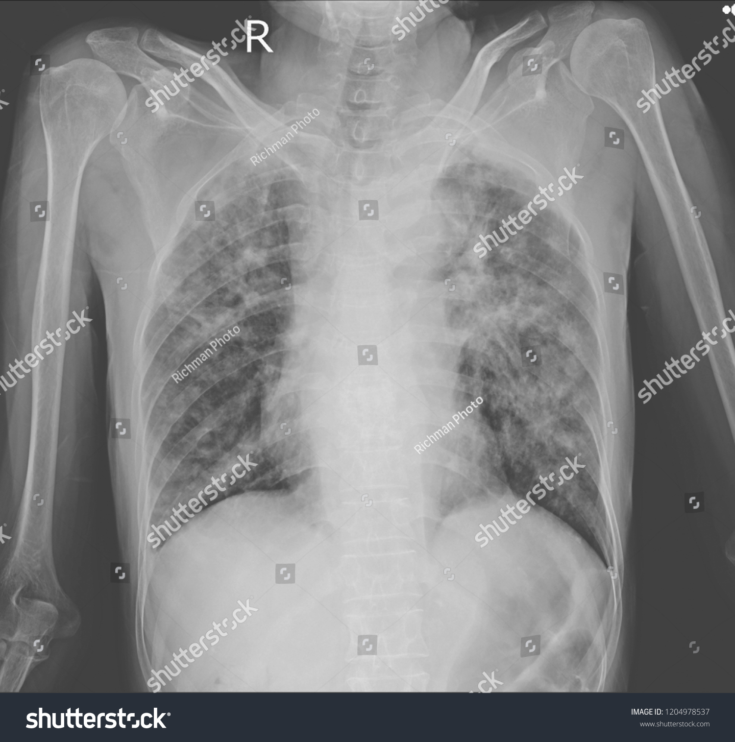 Chest Xray Showing Interstitial Pulmonary Infiltration Foto Stock Chest Xray Showing Interstitial Pulmonary Infiltration Foto Stock