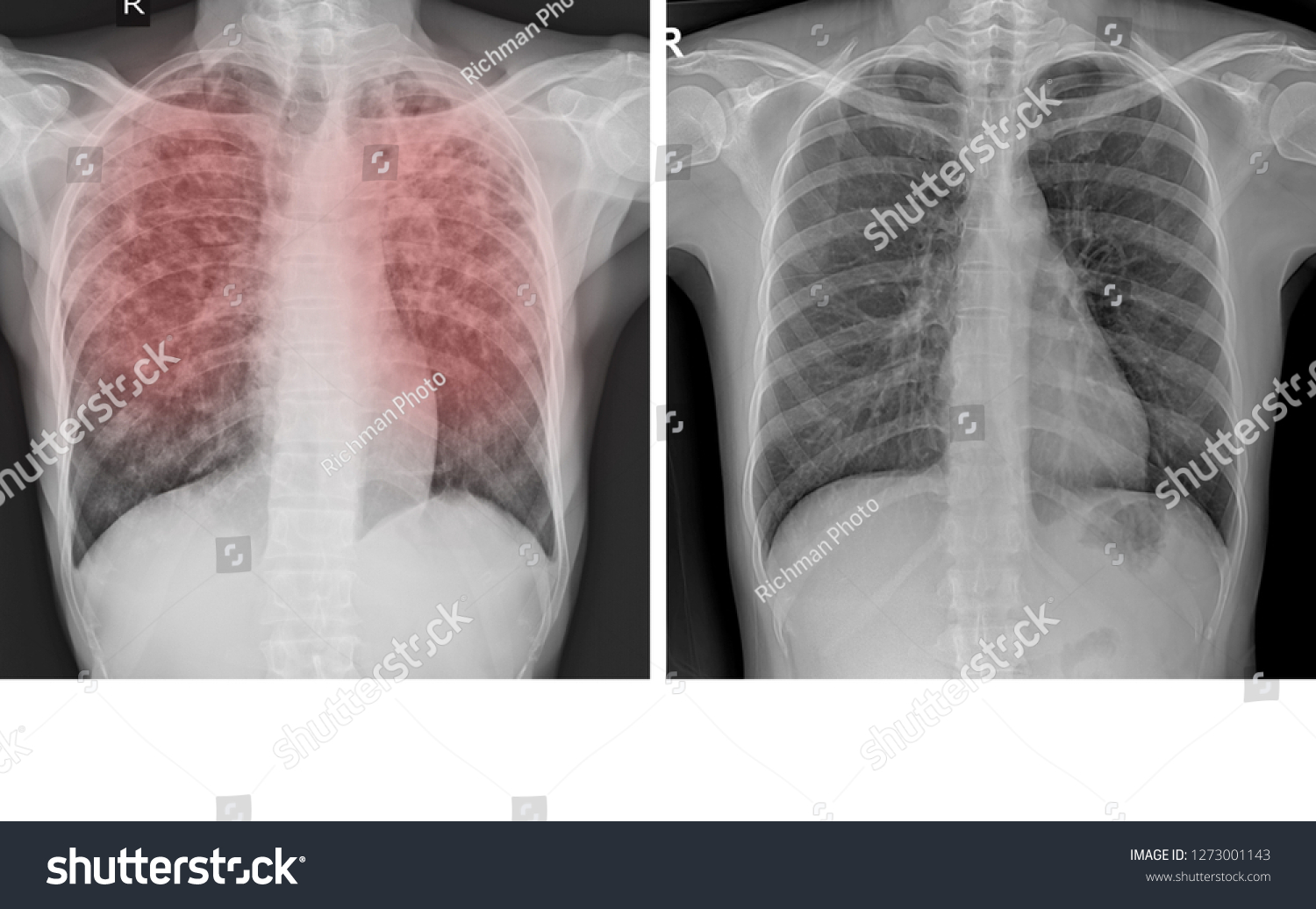 Chest Xray Showing Normal Chest Pulmonary Stock Photo 1273001143 ...