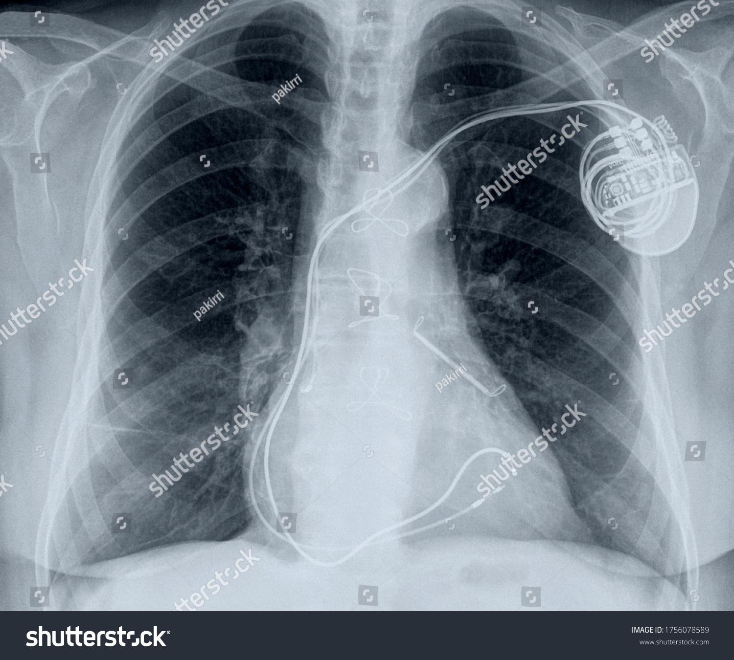 Chest Xray Cardiac Pacemaker Stock Photo (Edit Now) 1756078589