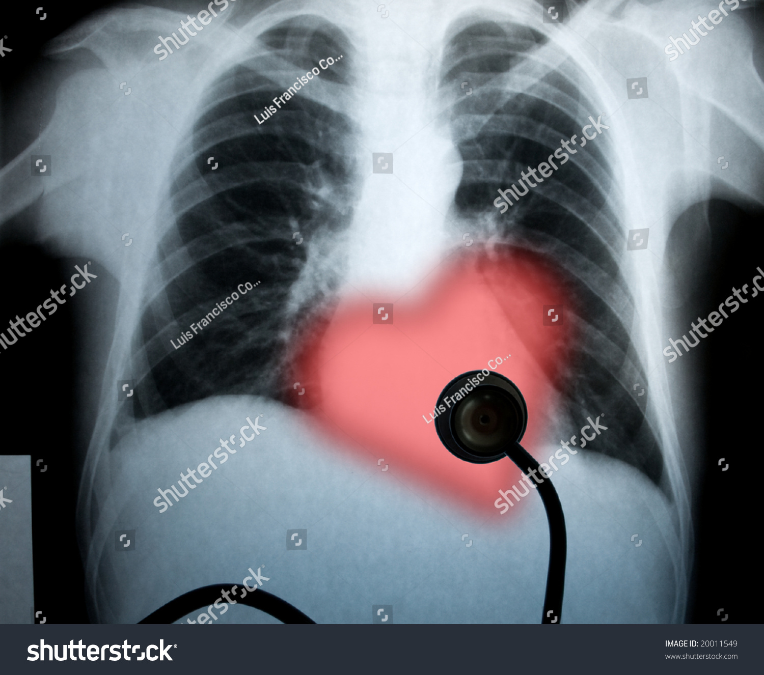 Chest Xray And Heart For Valentines Holiday Stock Photo 20011549 ...