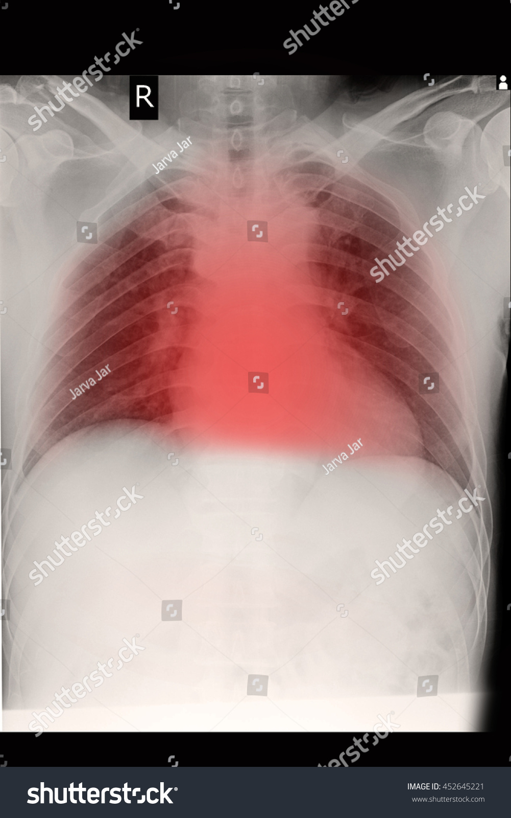 Chest Xray Show Cardiomegaly Abd Congestive Stock Photo (Edit Now ...