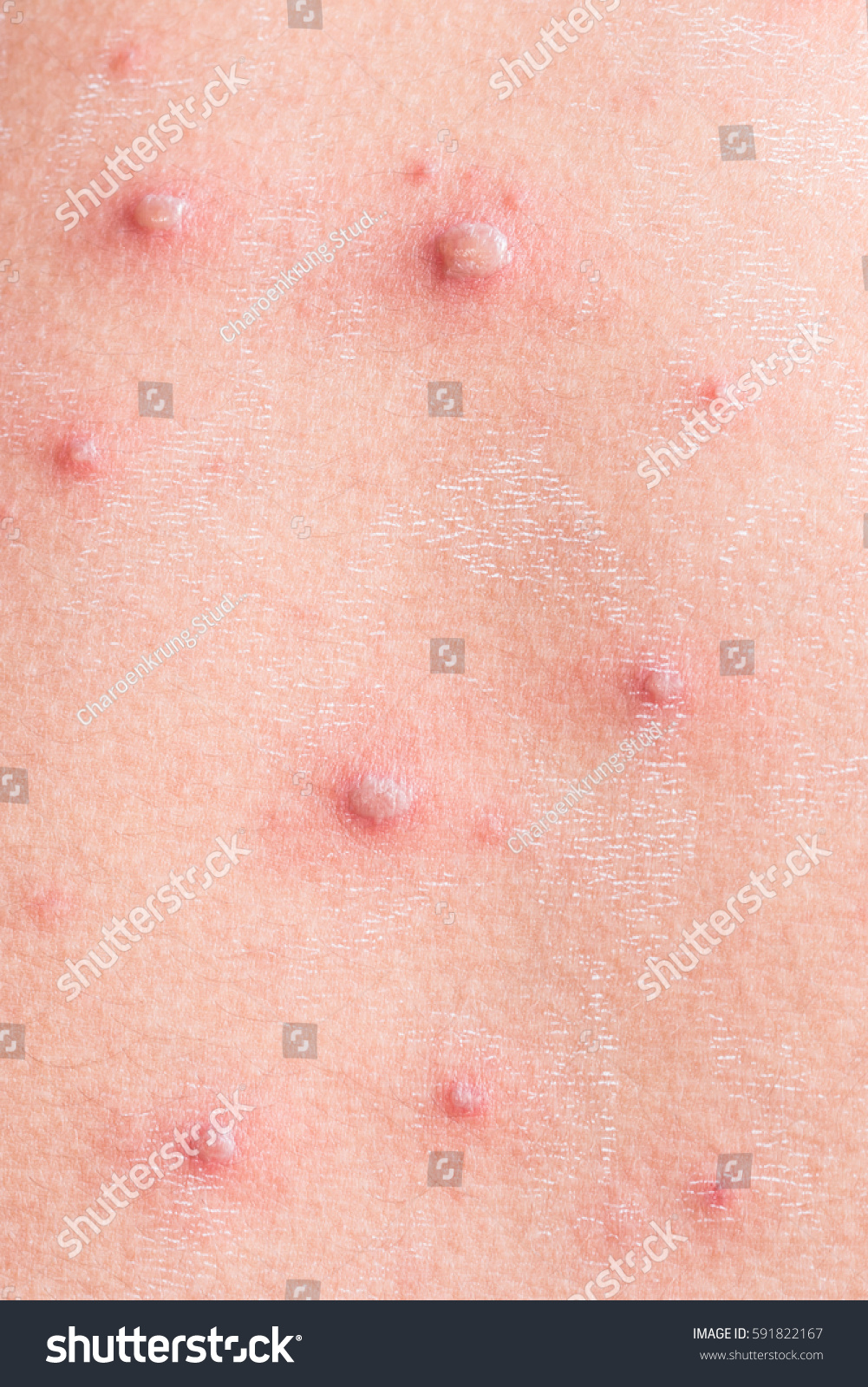 Chicken Pox Rash Viral Infections Chickenpox Stock Photo Edit Now