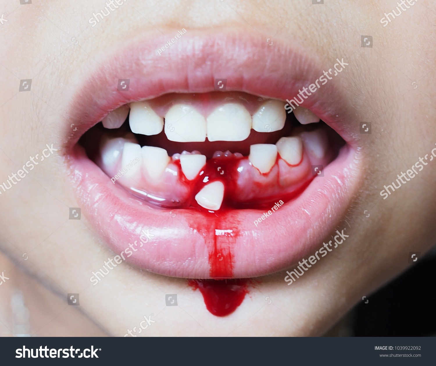 Asian ... Stock Children Photo Mouth (Edit Bleeding Lost First