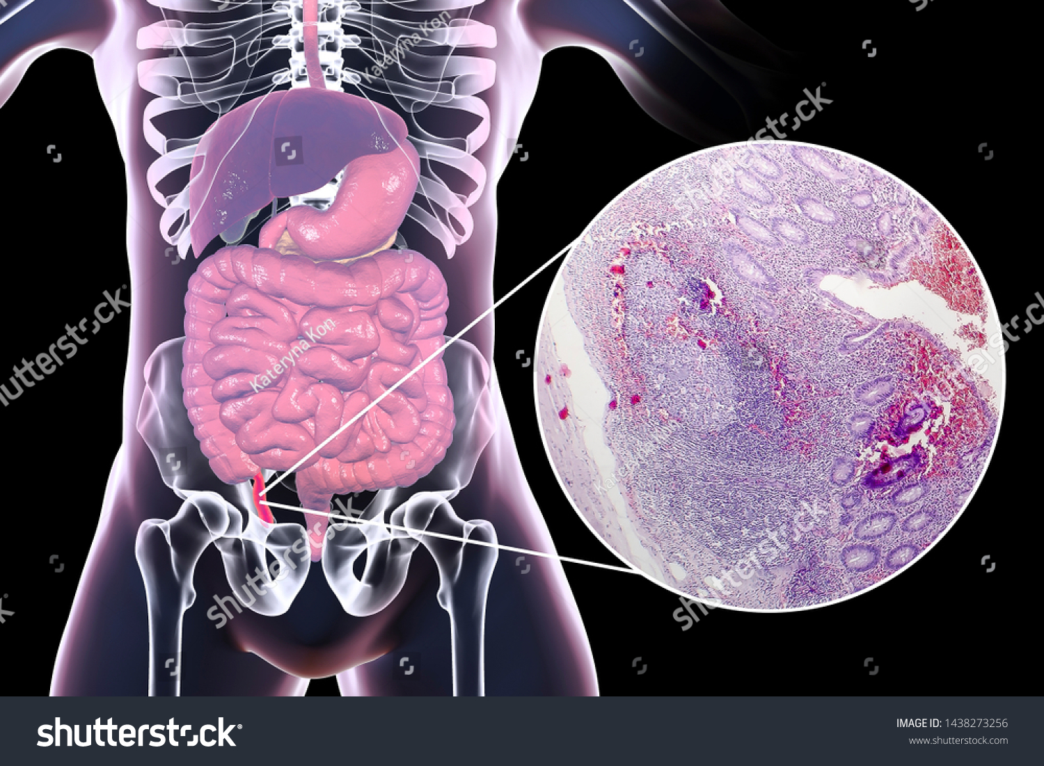 Chronic Appendicitis 3d Illustration Human Body Stock Illustration ...