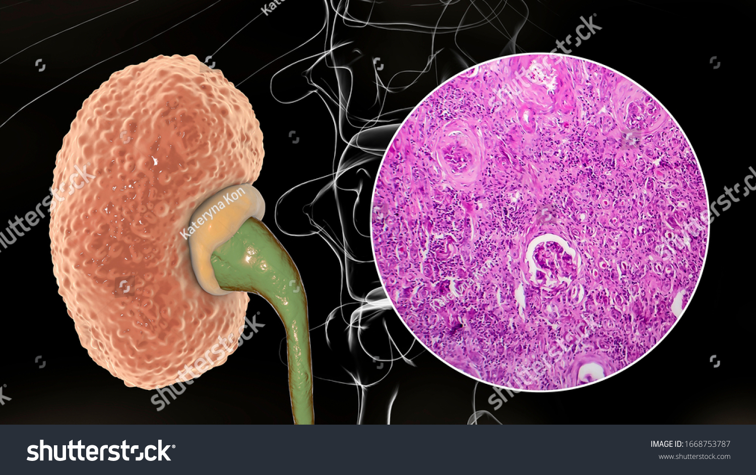 Glomerulonefritis Crónica, Ilustración 3D Que Muestra: Ilustración De ...