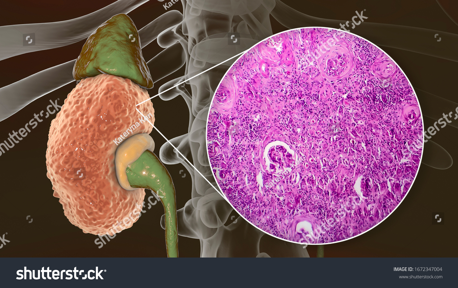 Chronic Glomerulonephritis 3d Illustration Showing Pale Stock ...